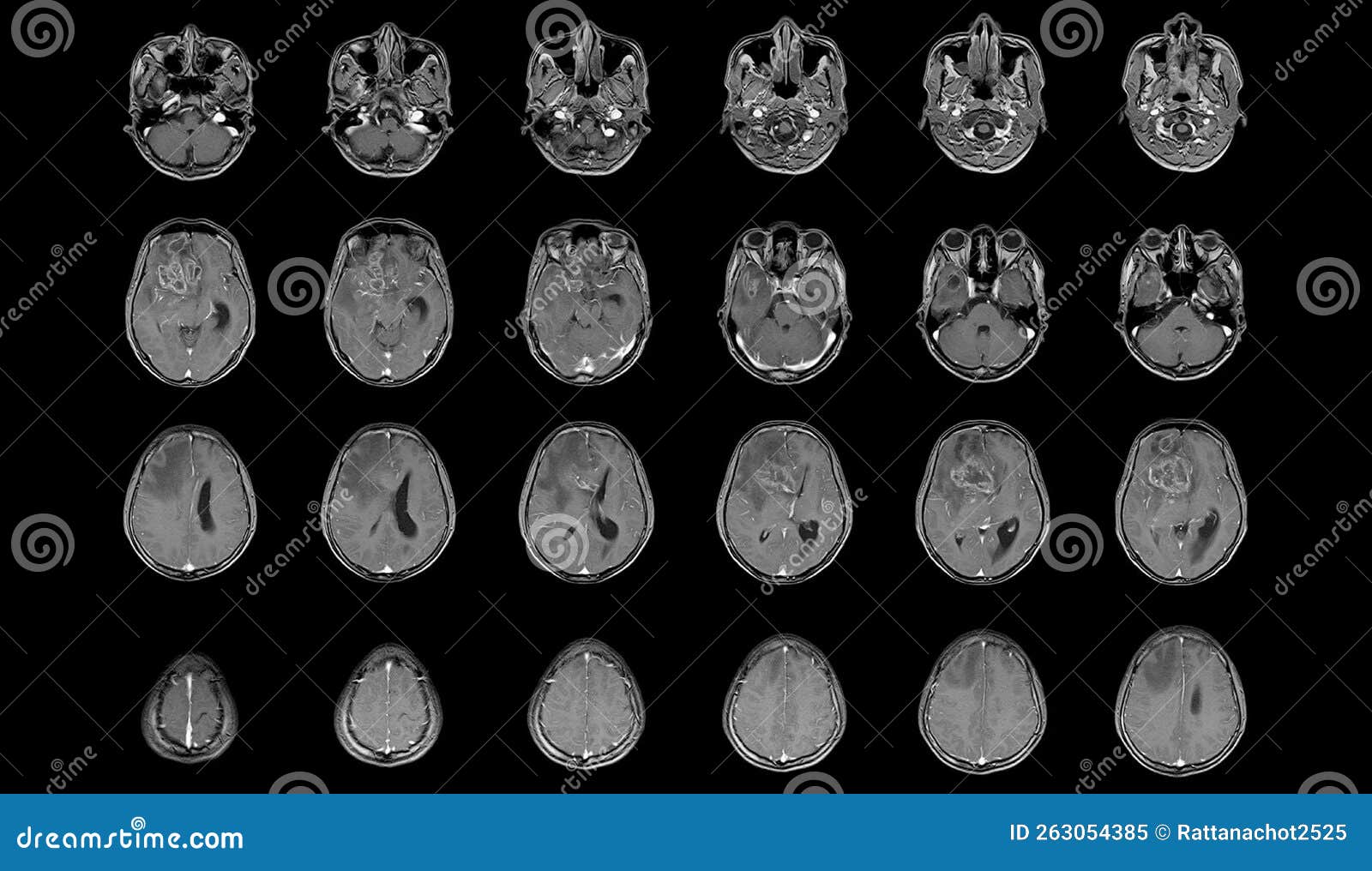 mri brain axial views .to evaluate brain tumor. glioblastoma, brain metastasis isodensity mass with an ill-defined margin and