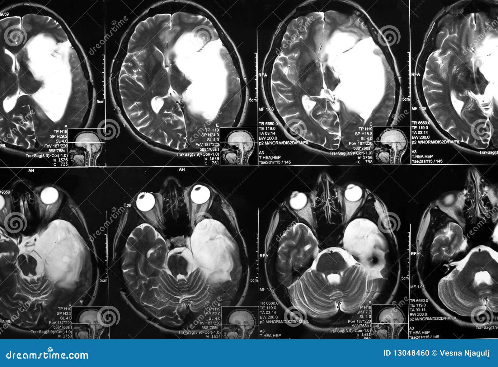 mri of the brain, brain tumor - mr