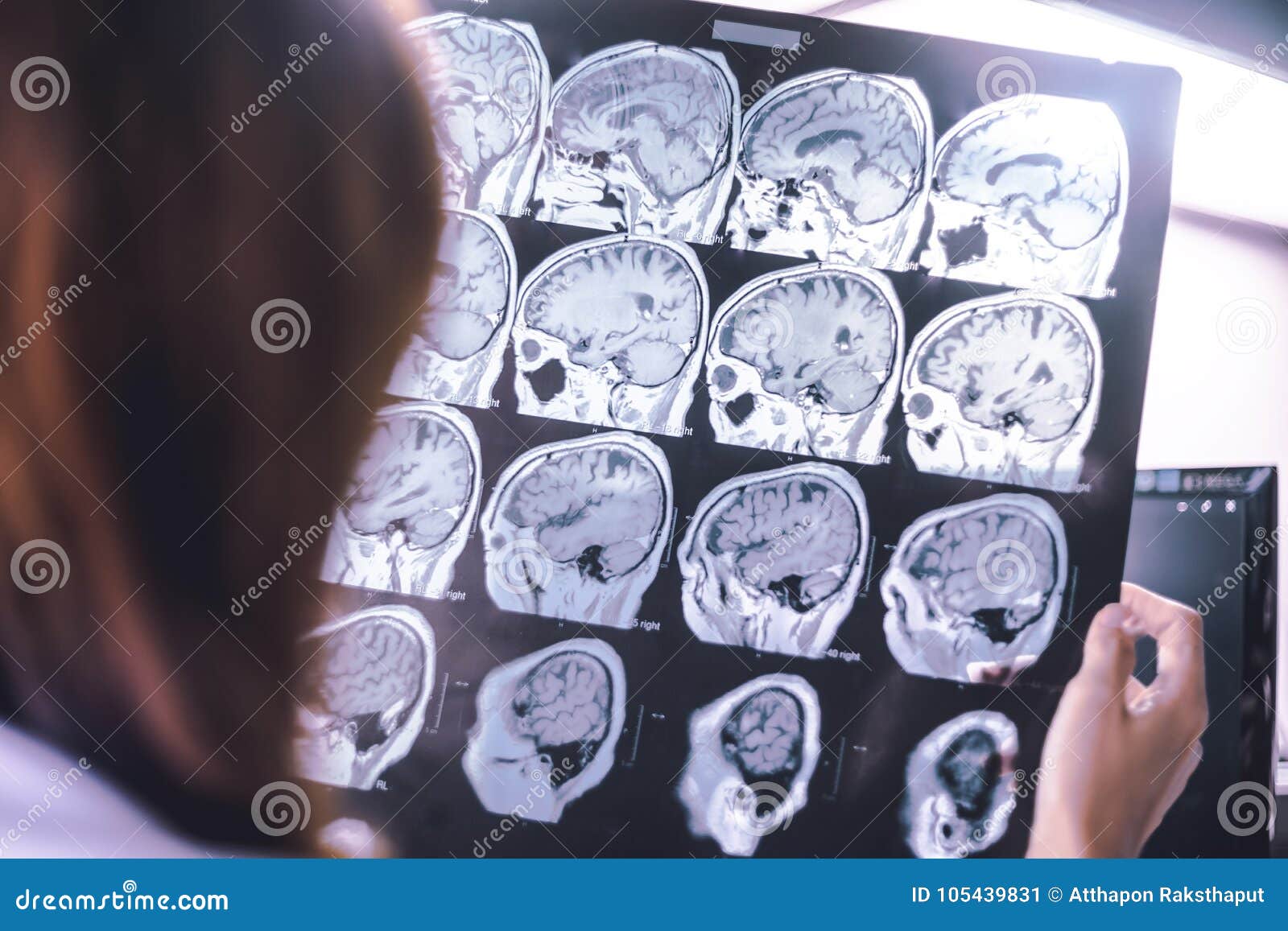 MRI brain Dementia stock image. Image of brain, neurology - 105439831