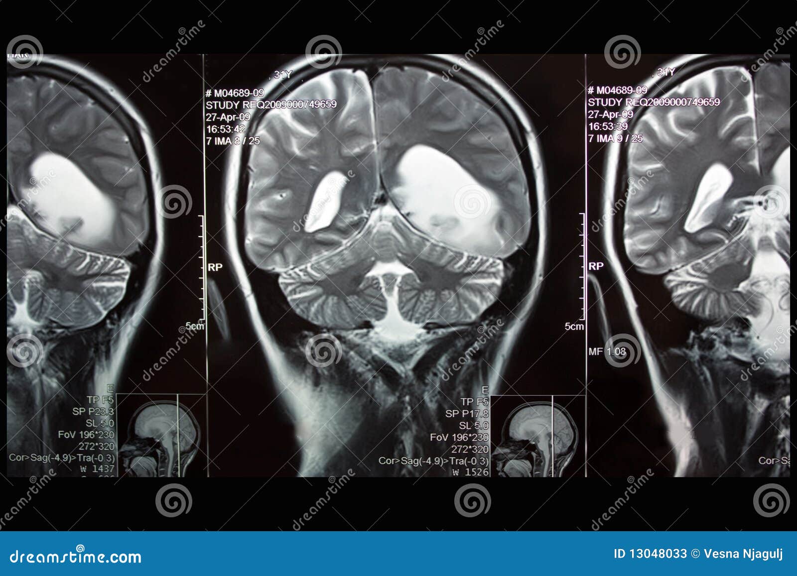 mri of brain, left hemisphere tumor, coronal plane