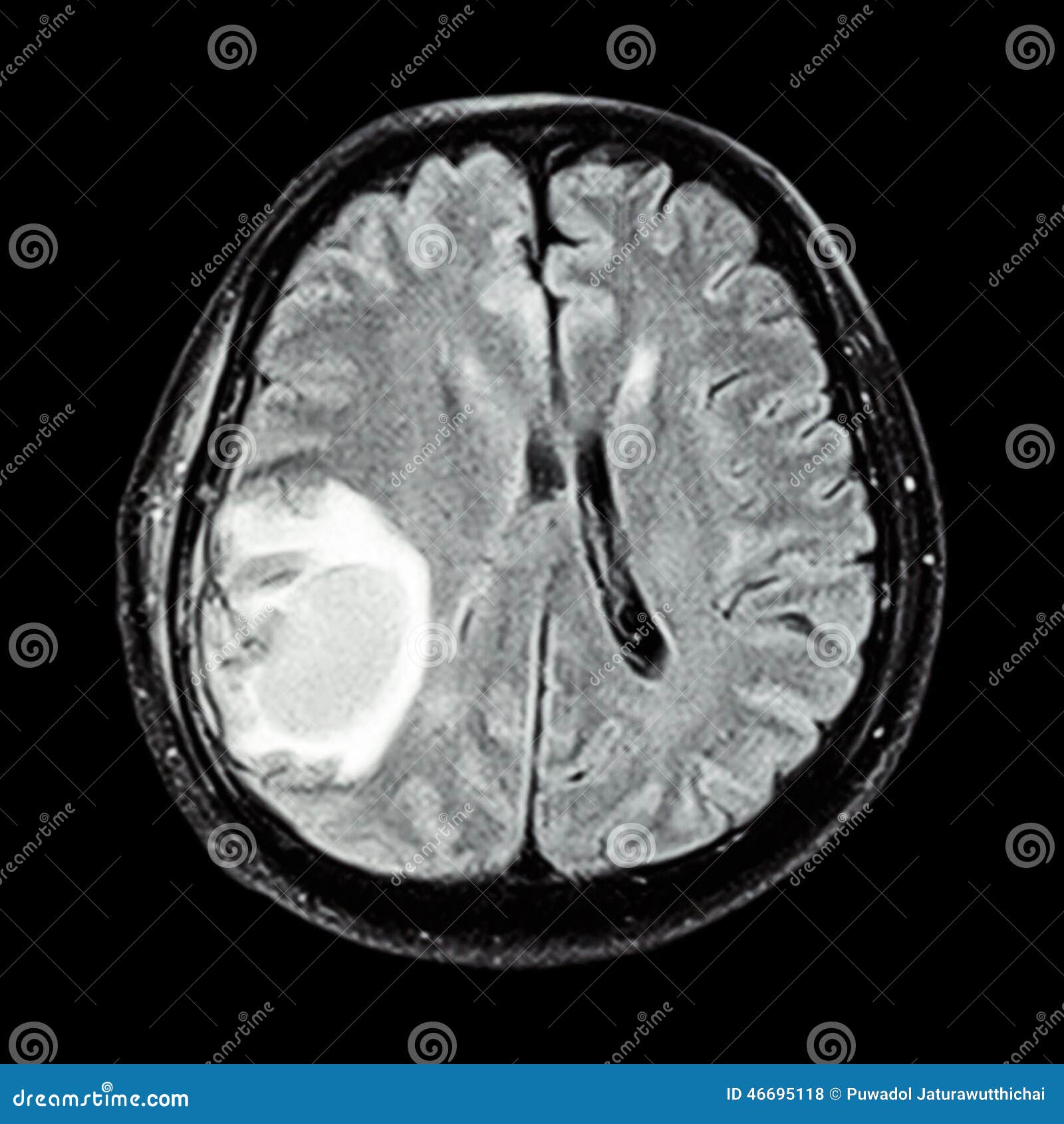 mri brain : show brain tumor