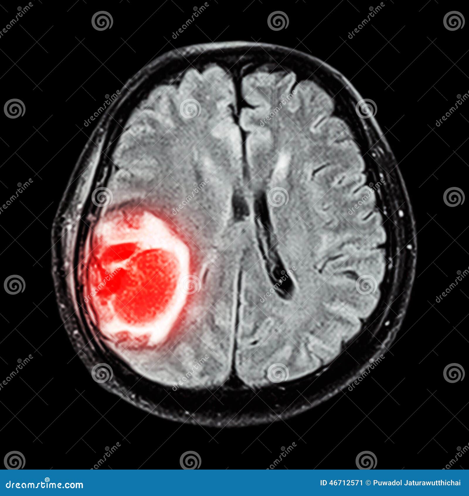 mri brain : show brain tumor at right parietal lobe of cerebrum
