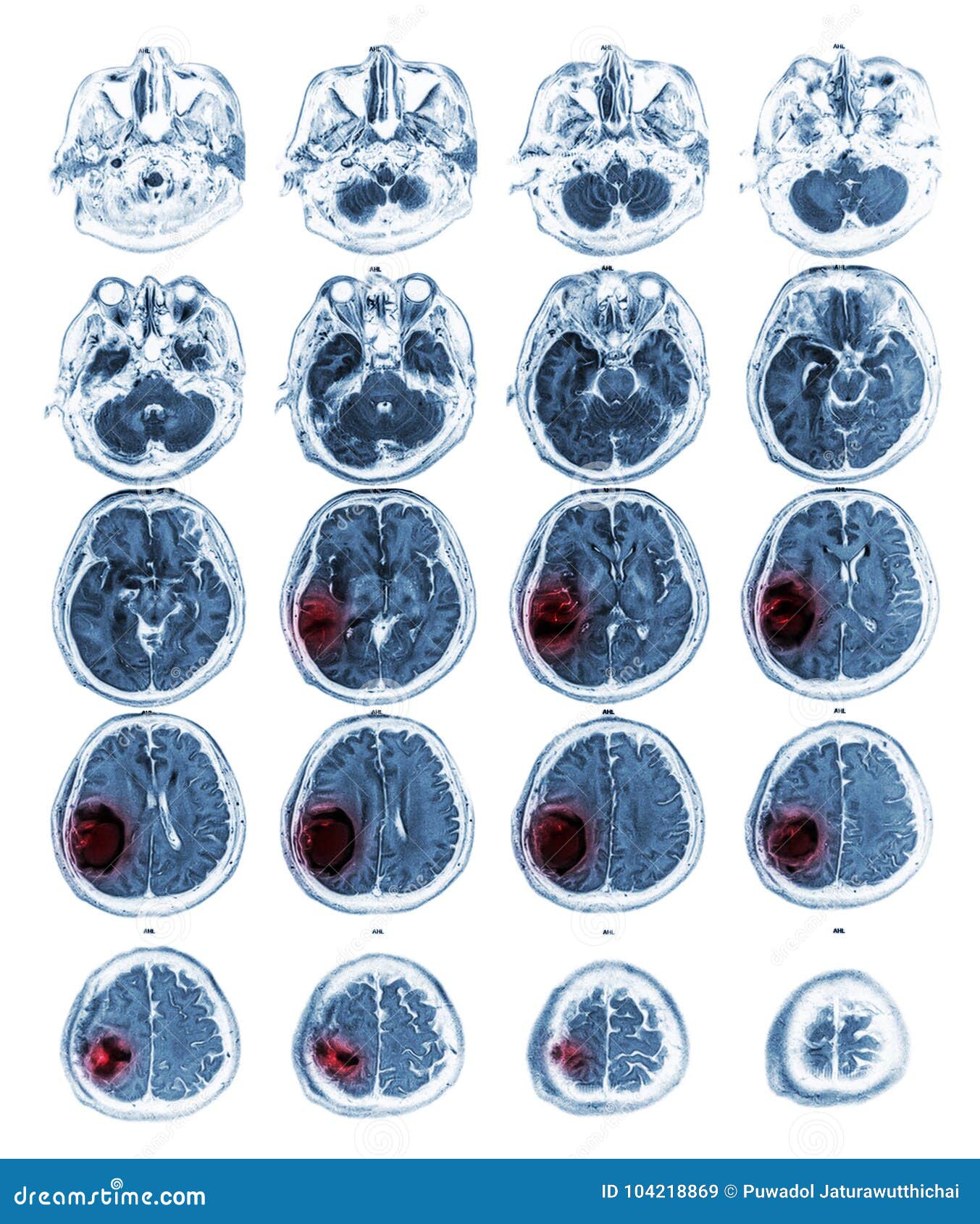 MRI Brain Show Brain Tumor at Right Parietal Lobe Stock Image Image