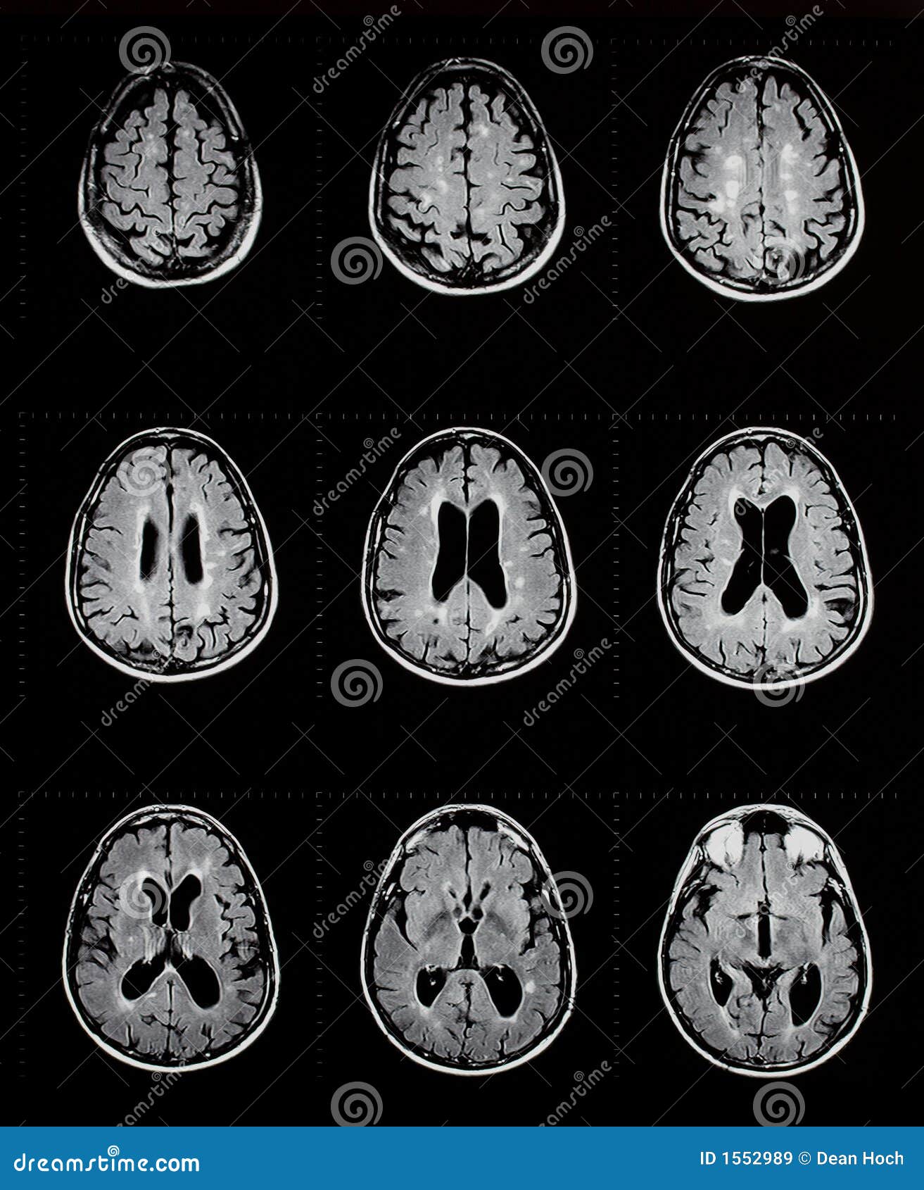 mri of brain showing multiple sclerosis