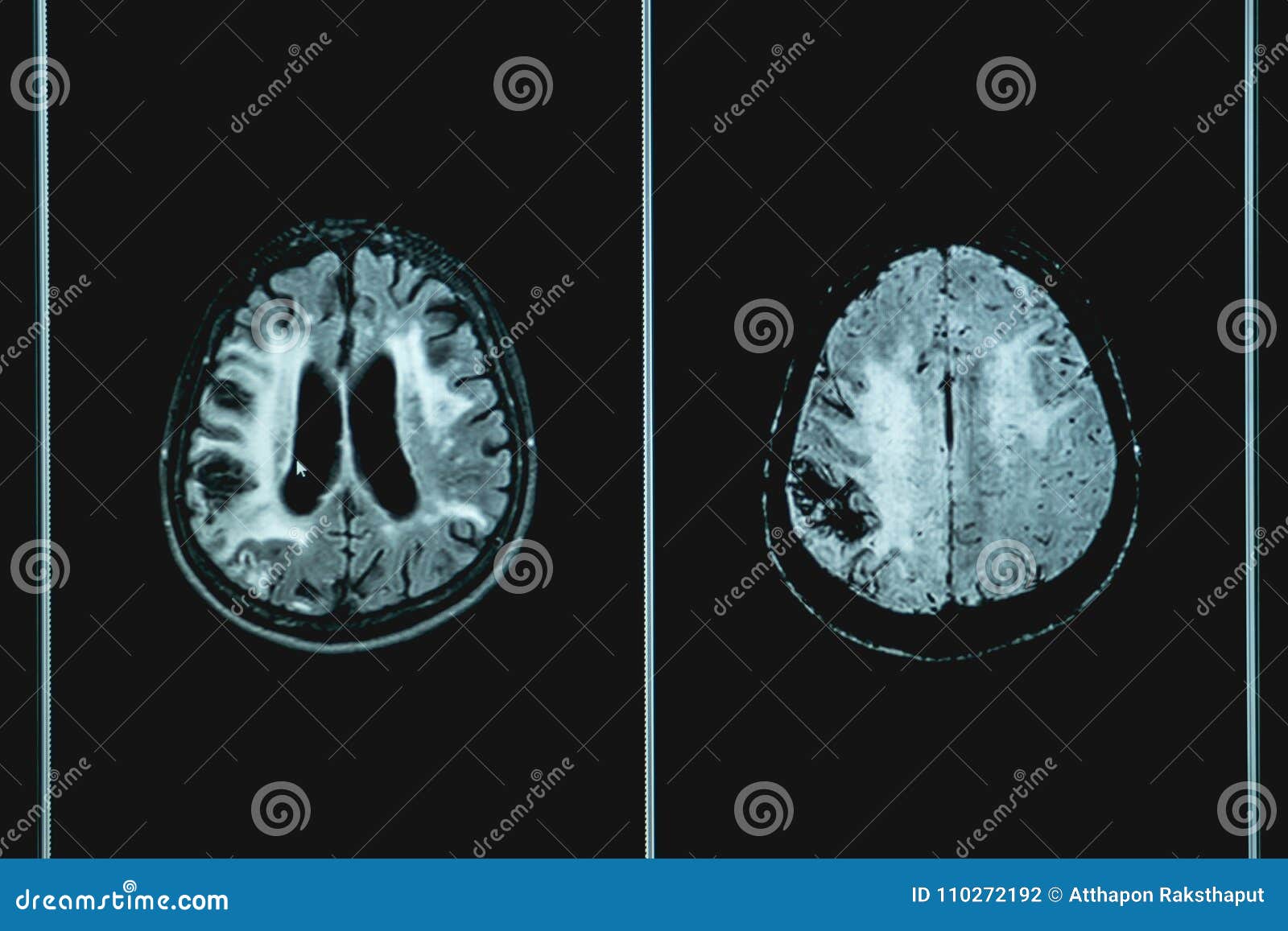 MRI Brian of Dementia Patient Stock Photo - Image of imaging, science