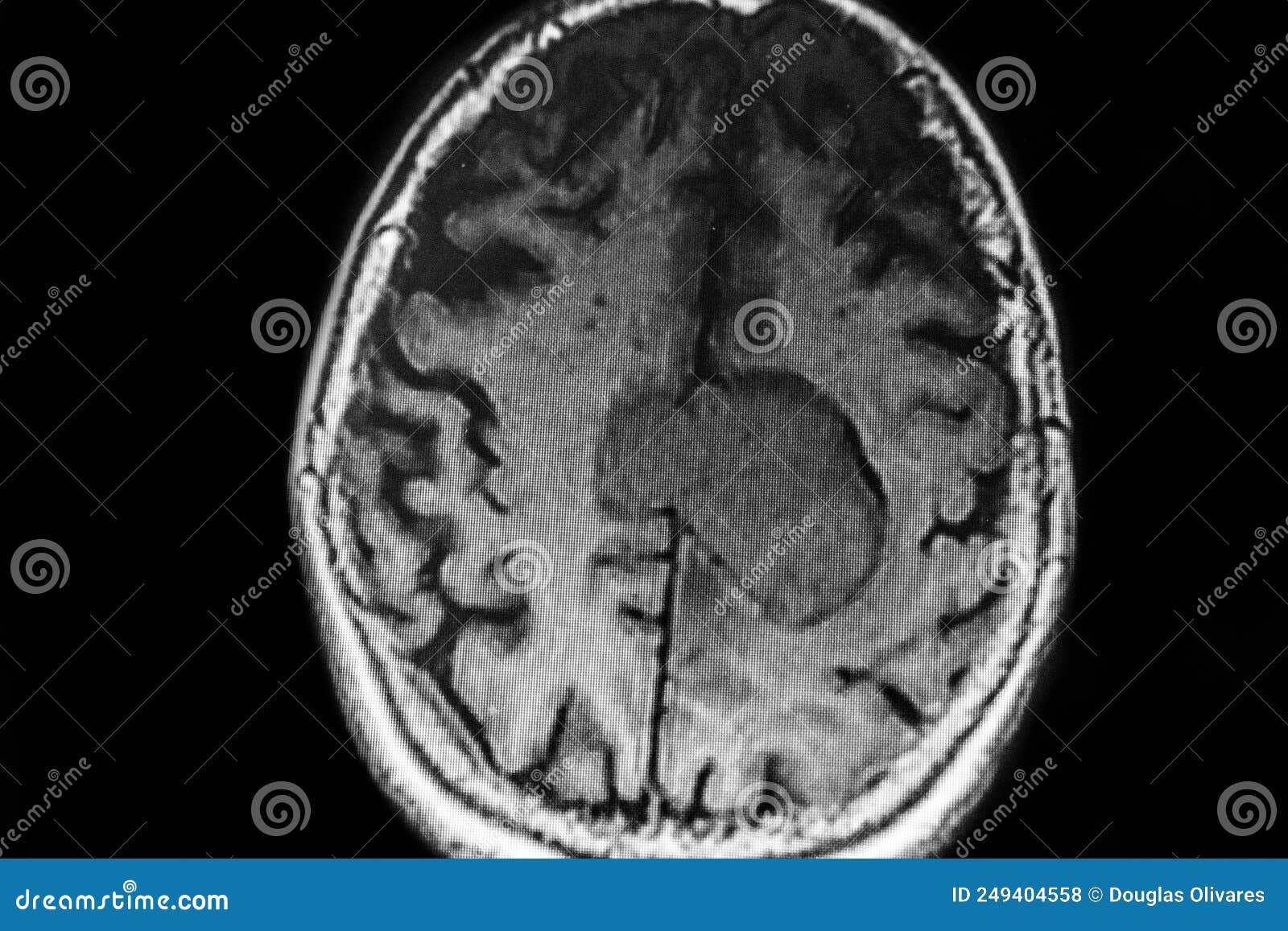 mri image of cerebral lesion located in the middle line parietal -frontal area