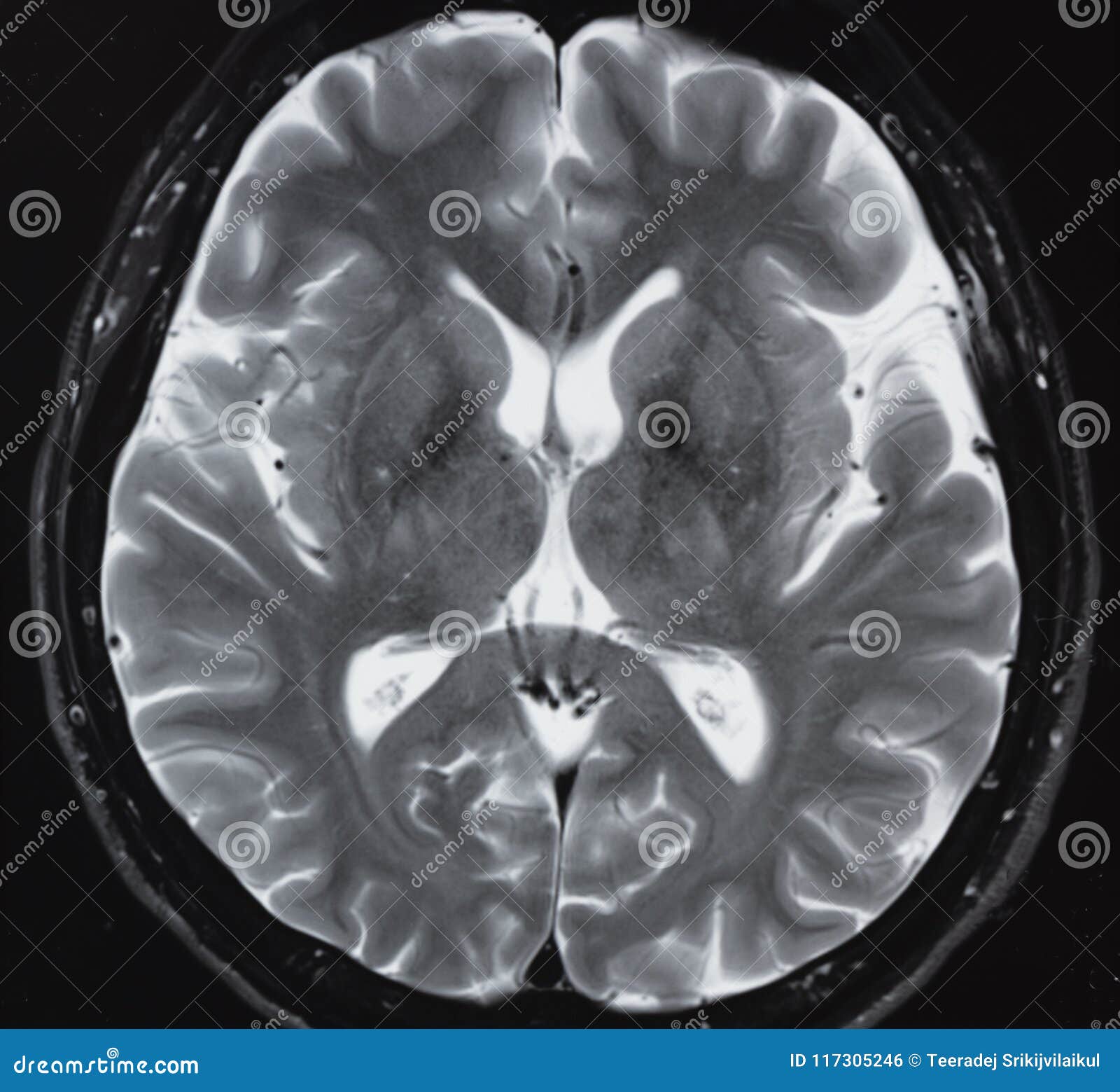 Resonancia Magnética De La Anatomía Normal Del Cerebro Humano Foto de  archivo - Imagen de nervioso, cerebral: 117305246, image size:1600x1559