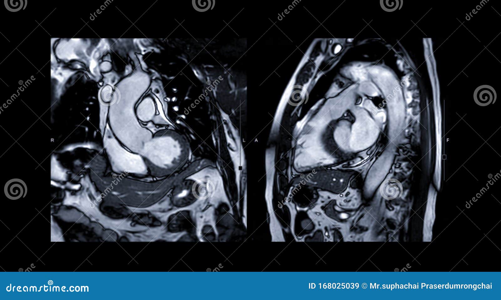 mri heart or cardiac mri  magnetic resonance imaging  of heart compare rvot and lvot.