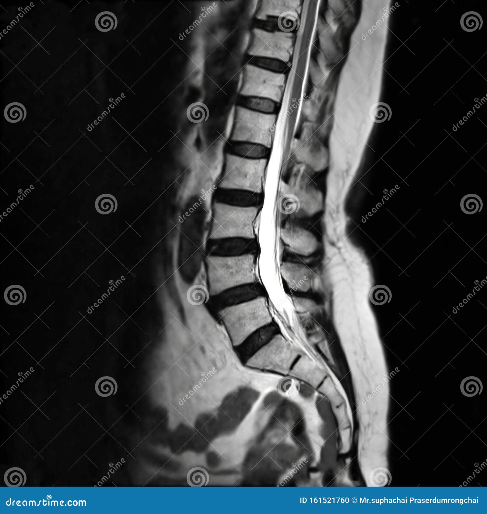 https://thumbs.dreamstime.com/z/mri-l-s-spine-mri-lambosacral-spine-mri-l-s-spine-mri-lambosacral-spine-l-s-spine-sagittal-plane-t-technique-161521760.jpg