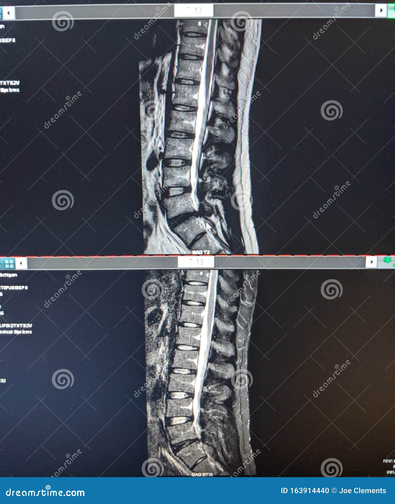 MRI Lower Back Lumbar Herniation Herniated Stock Photo Image of lower