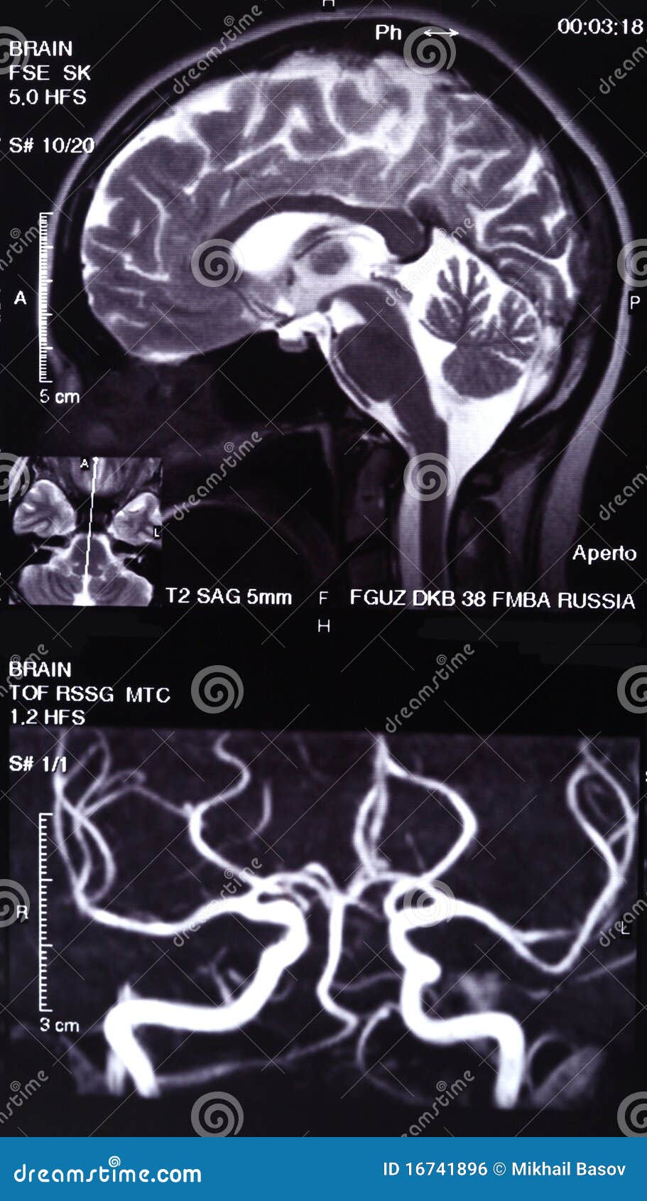 MRI and MR angiography stock photo. Image of imaging 16741896