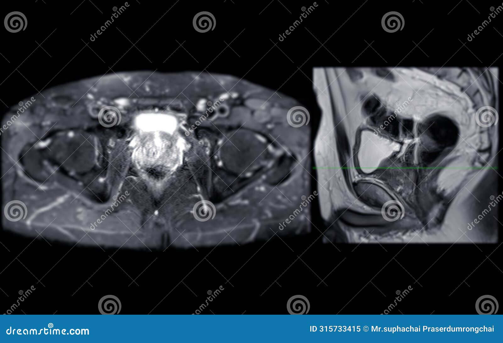 mri of the prostate gland reveals focal abnormal si lesion at left pzpl at apex as described; pi-rads category 4, clinically