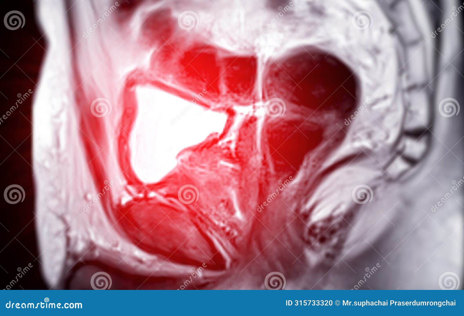 mri of the prostate gland reveals focal abnormal si lesion at left pzpl at apex as described; pi-rads category 4, clinically