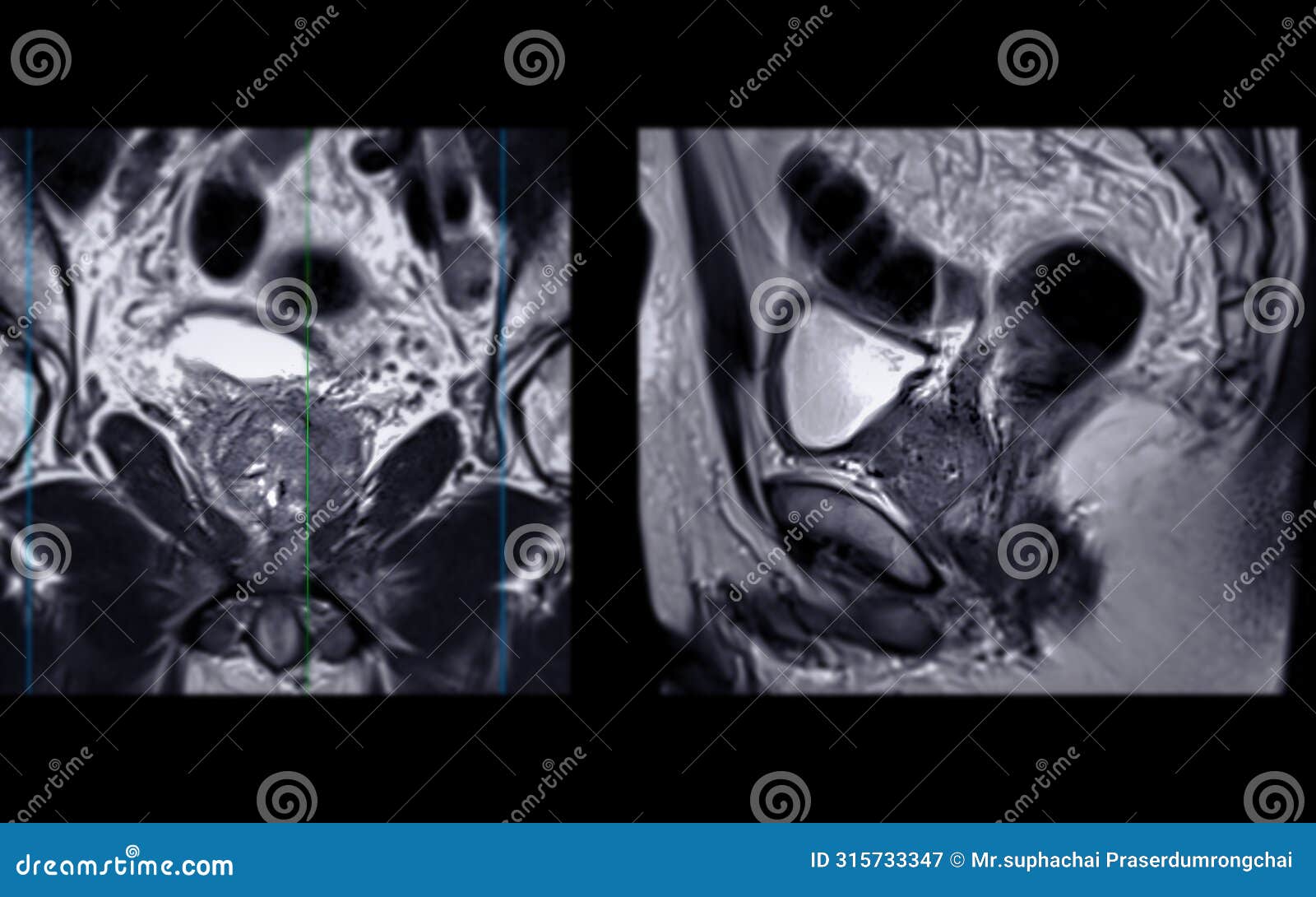 mri of the prostate gland reveals focal abnormal si lesion at left pzpl at apex as described; pi-rads category 4, clinically