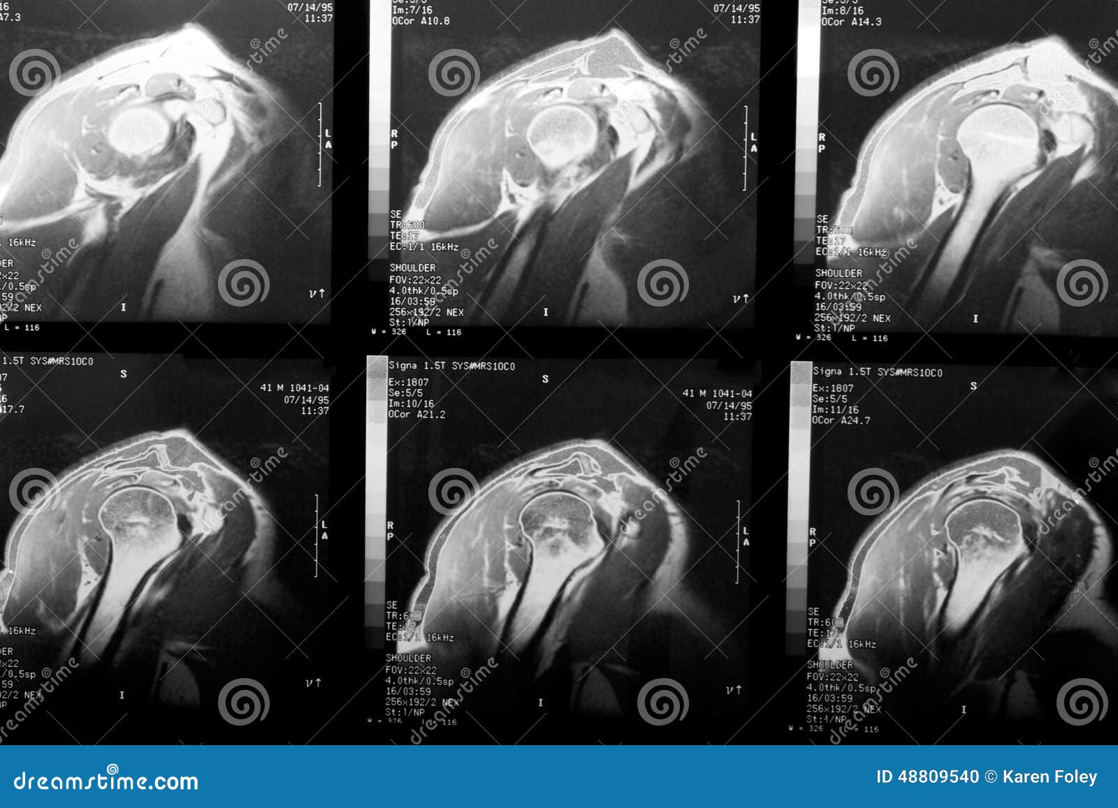 Rotator Cuff Tear X Ray