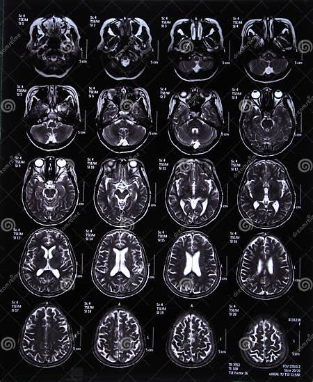 MRI scan image of brain stock photo. Image of human, diagnosis - 34023772