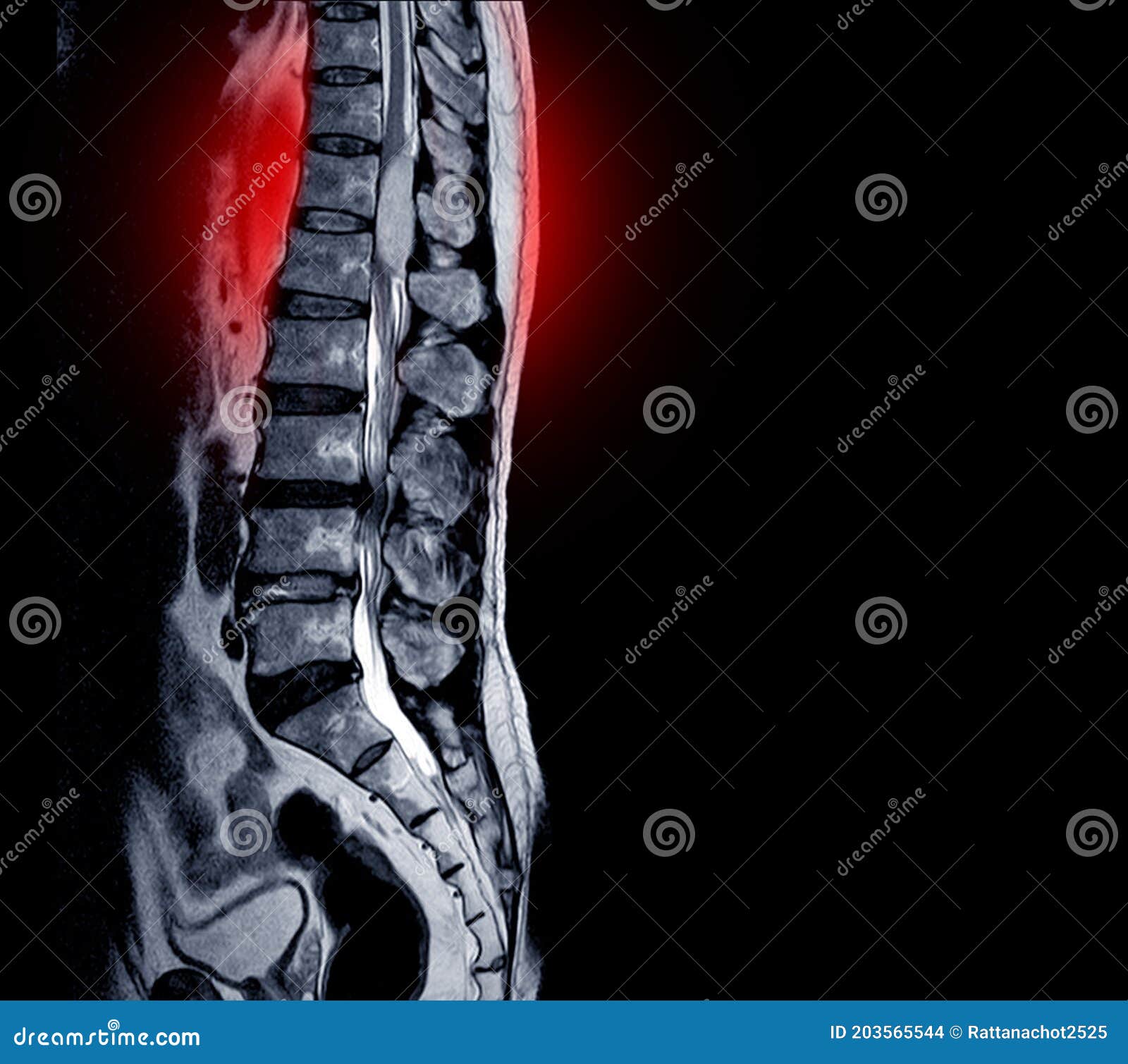 MRI Scan of Lumbar Spines of a Patient Finding Spinal Mass at Lt.side