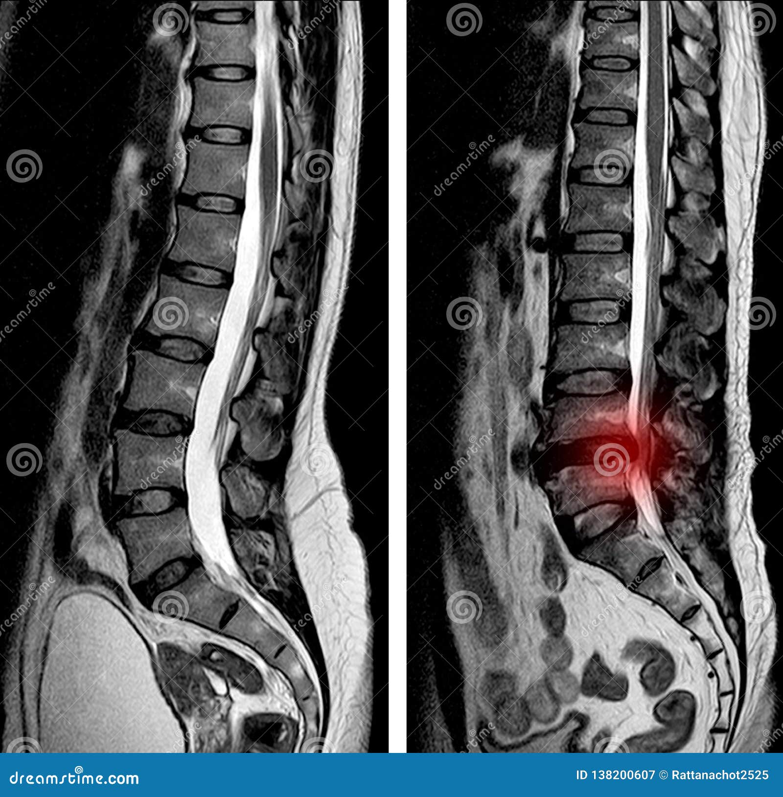 X-ray Of Lumbosacral Spine, Frontal Sagital View Scoliosis Royalty-Free