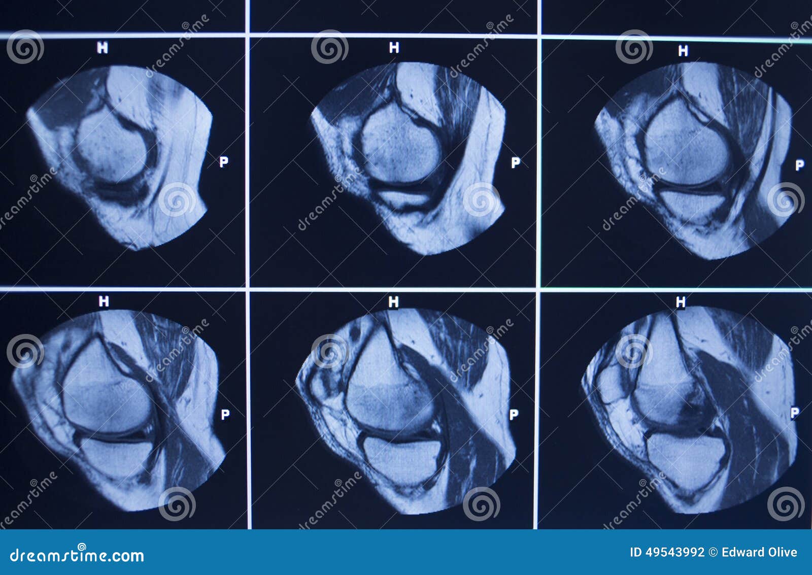 MRI Scan Test Results Knee Meniscus Injury Stock Photo - Image of copy,  knee: 49543992