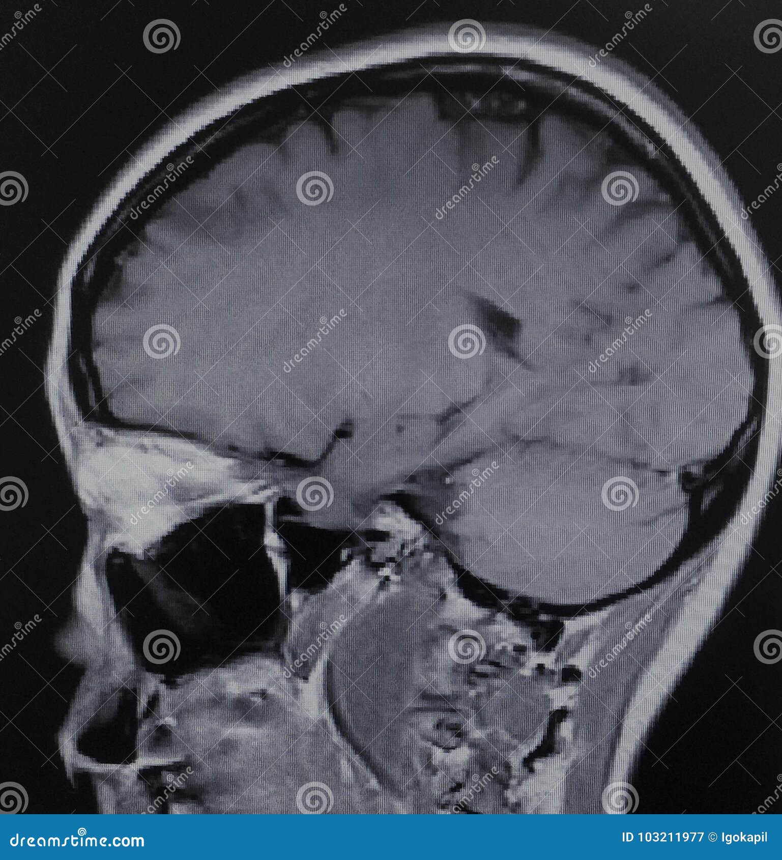 Mri Schwannoma Brain Acoustic Neuroma Exam Stock Image - Image of ...