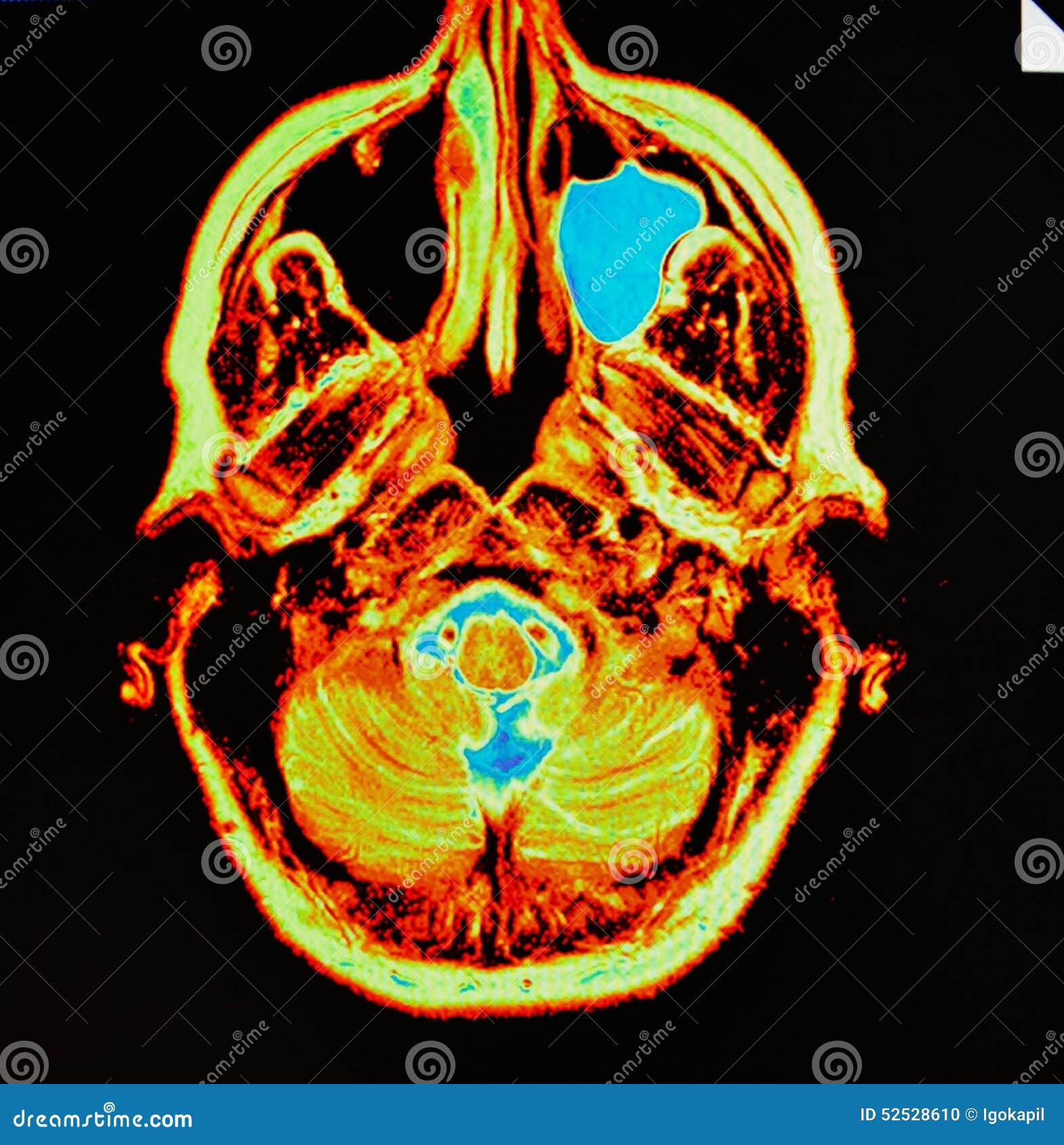 mri of sinusitis