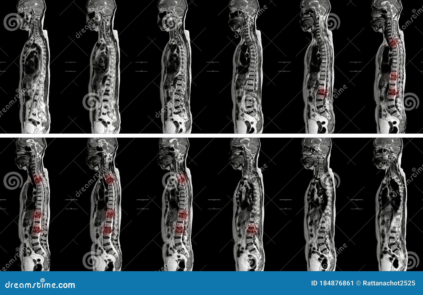 MRI of THORACOLUMBAR SPINE IMPRESSION: Moderate Pathological Compression of  T11 and L2 Levels with Enhancing Multiple Marrow Stock Image - Image of  backbone, diagnosis: 184876861