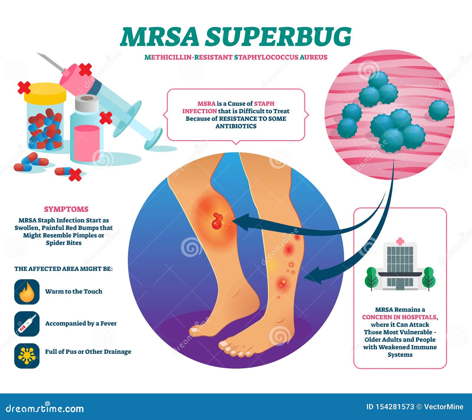 mrsa super bug  . labeled staph infection explain scheme.