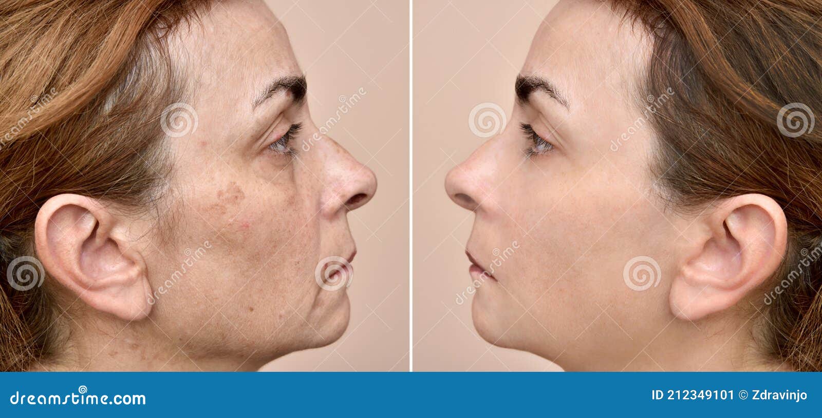 Mujer Antes Y Después De Aplicar Maquillaje Y Quitarse Las Bolsas De Los  Ojos Imagen de archivo - Imagen de facial, cosmético: 212349101