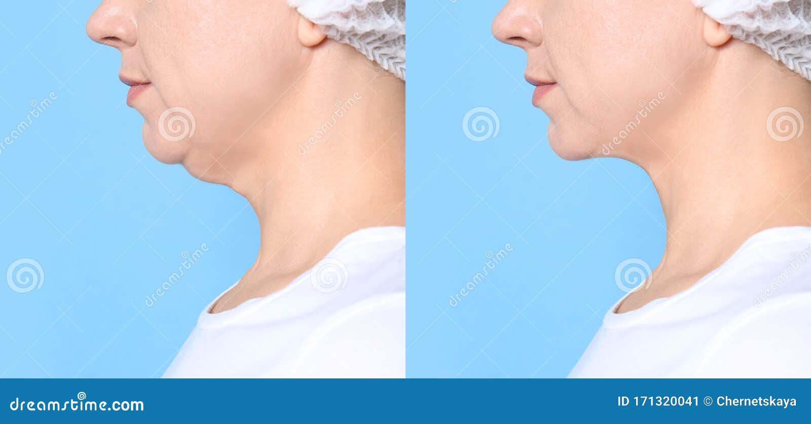 Mulher Madura, Antes E Depois Da Cirurgia Plástica, Operando Em