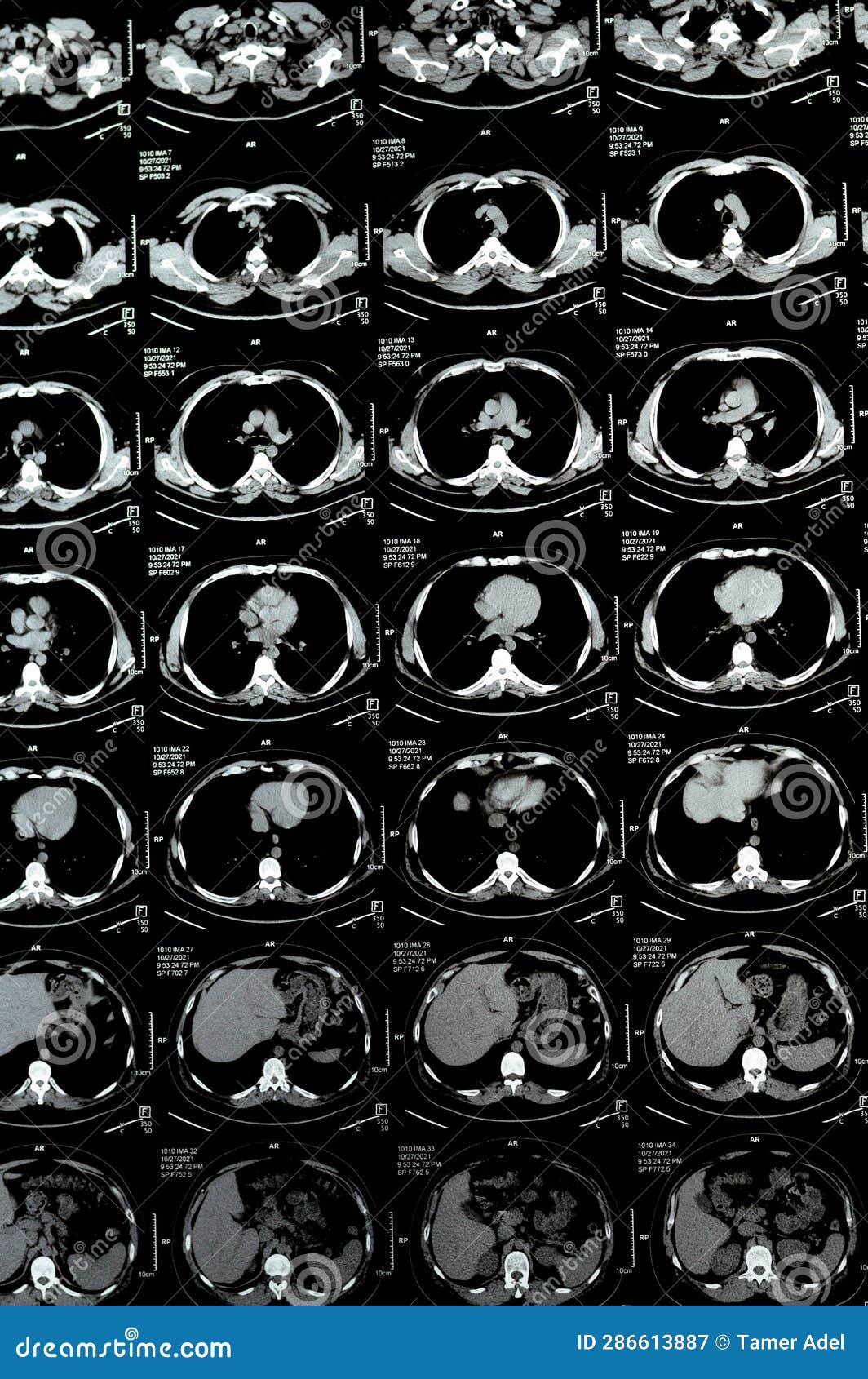 multi slice ct scan of the chest showing normal study, normal appearance of the lungs, parenchyma, pulmonary vasculature,