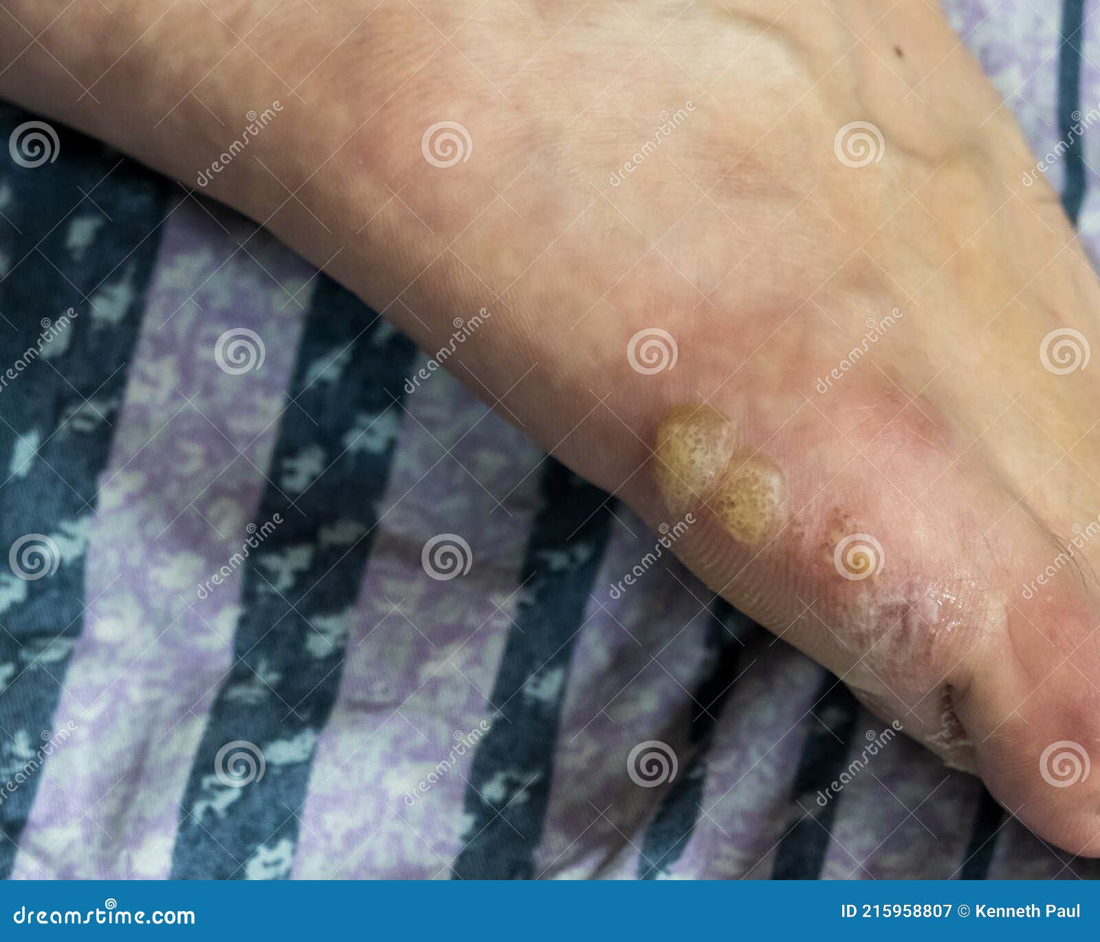 Multiple Blisters On Foot Stock Image Image Of Foot 215958807