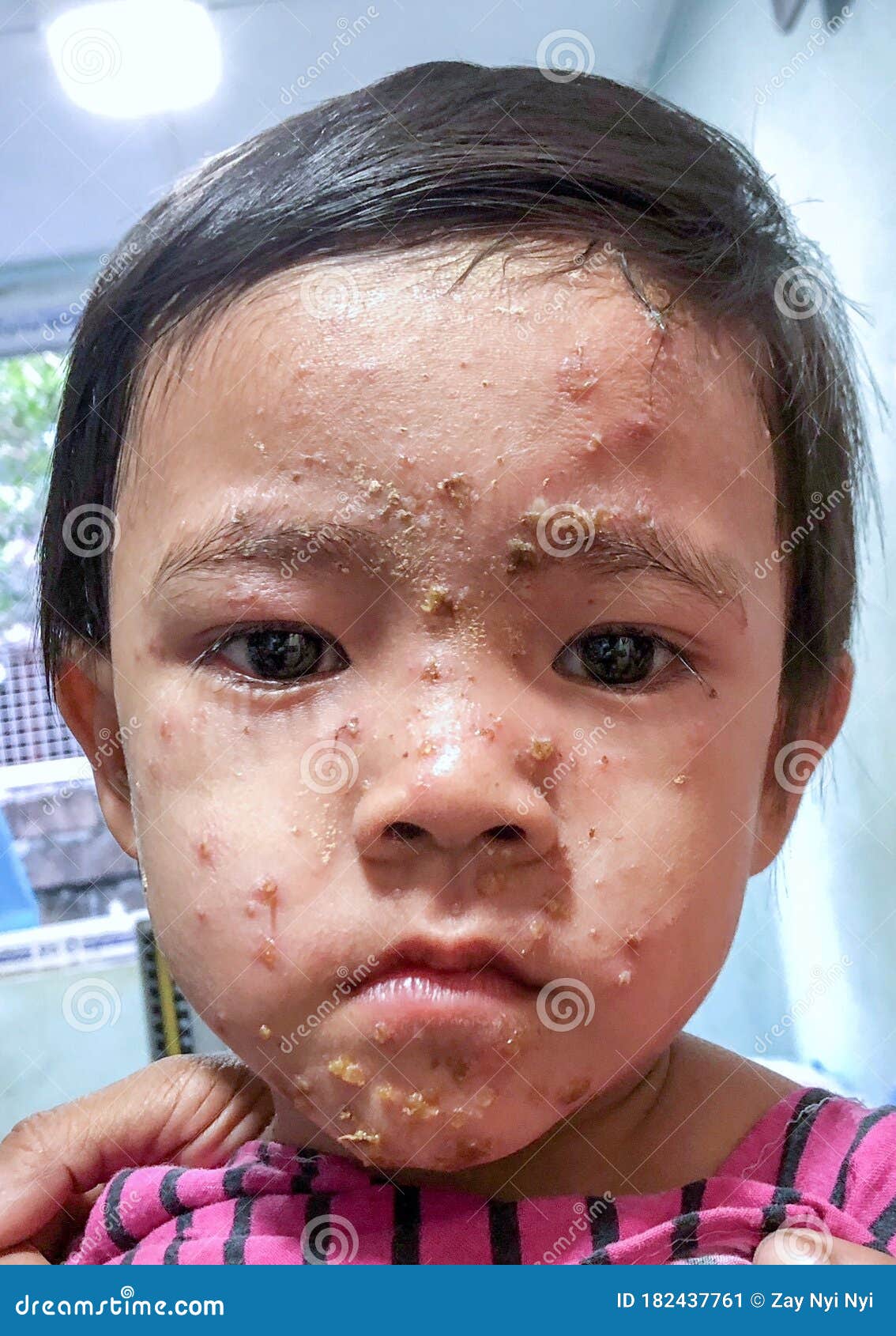 impetigo in children face