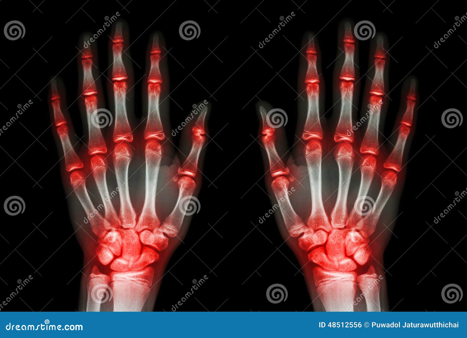 Multiple Joint Arthritis Both Hands ( Gout , Rheumatoid ) On Black