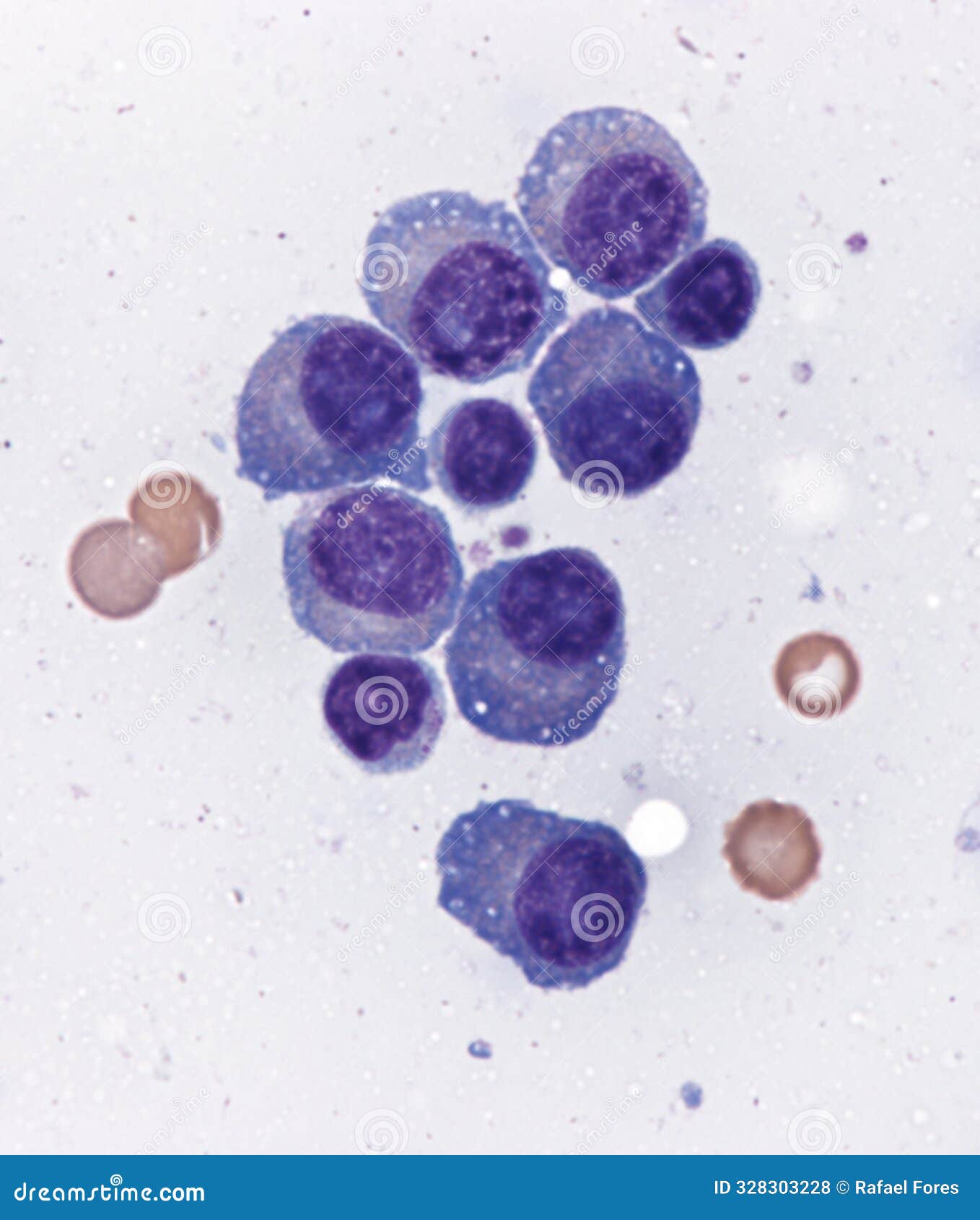 multiple myeloma in the bone marrow.