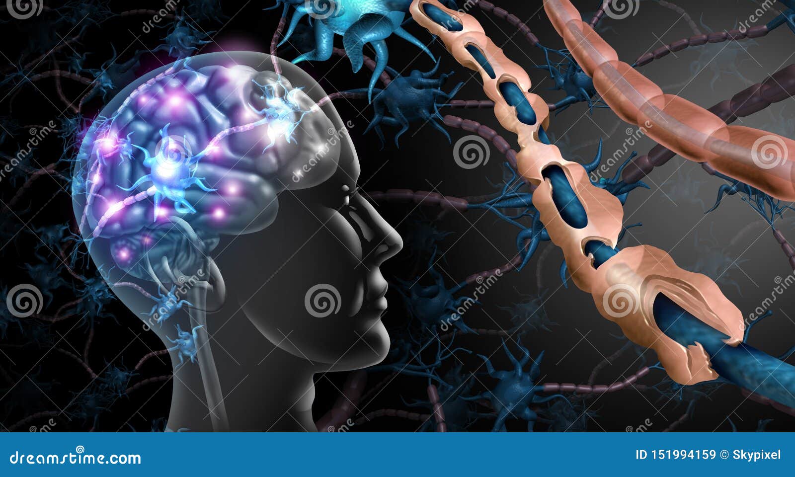 multiple sclerosis nerve disorder