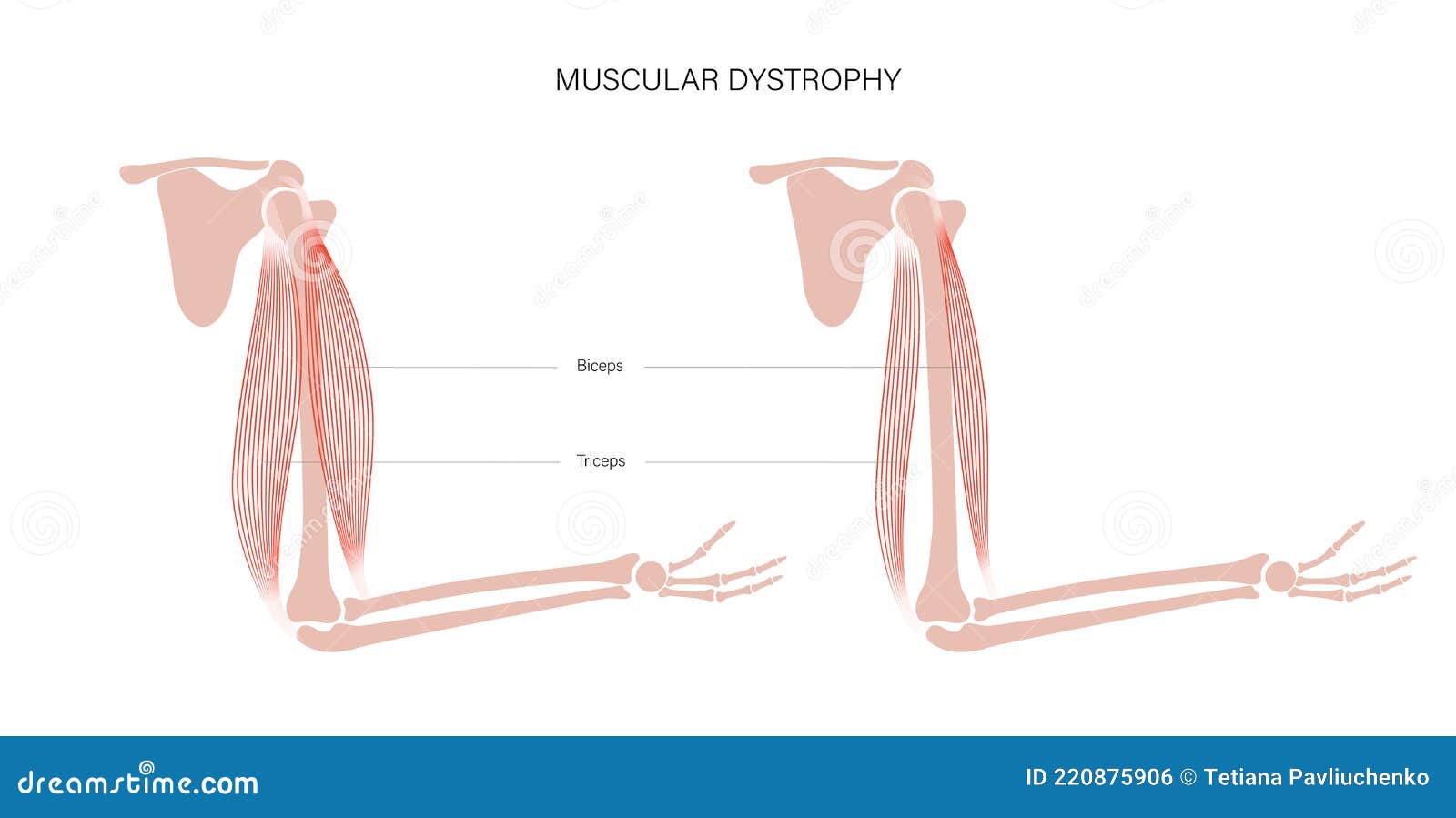 muscular dystrophy of arm