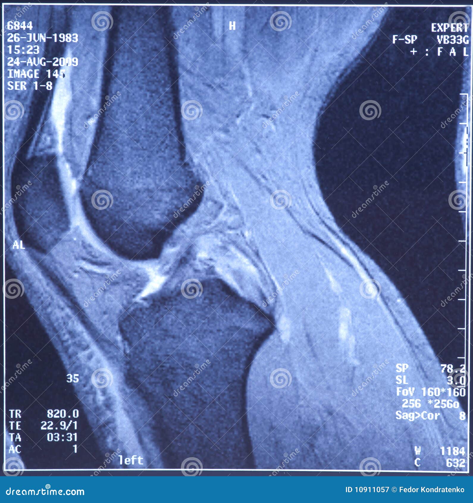 My Knee MRI Damage of Crossshaped Ligaments Stock Image Image of