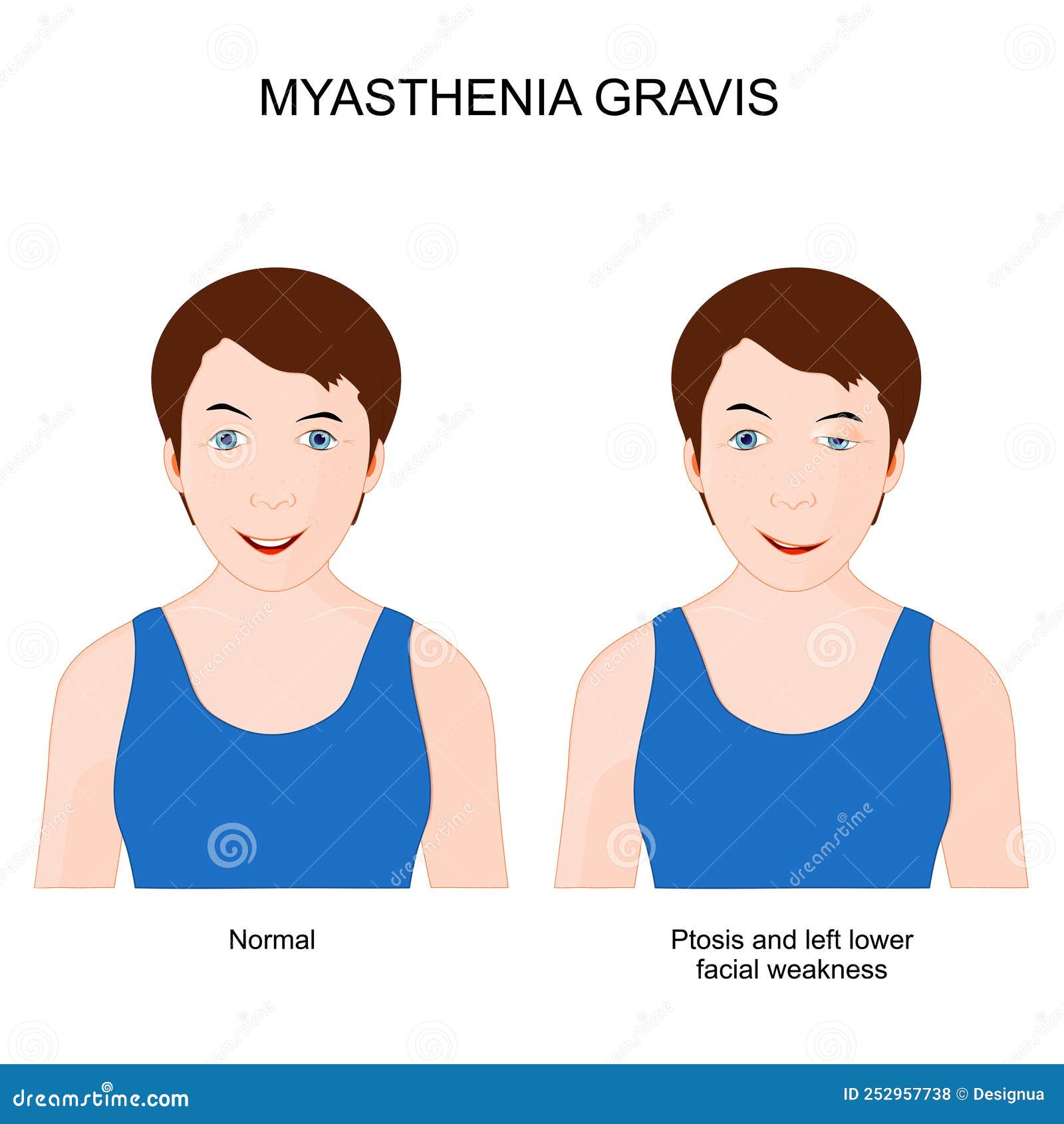 myasthenia gravis. girl with neuromuscular disease