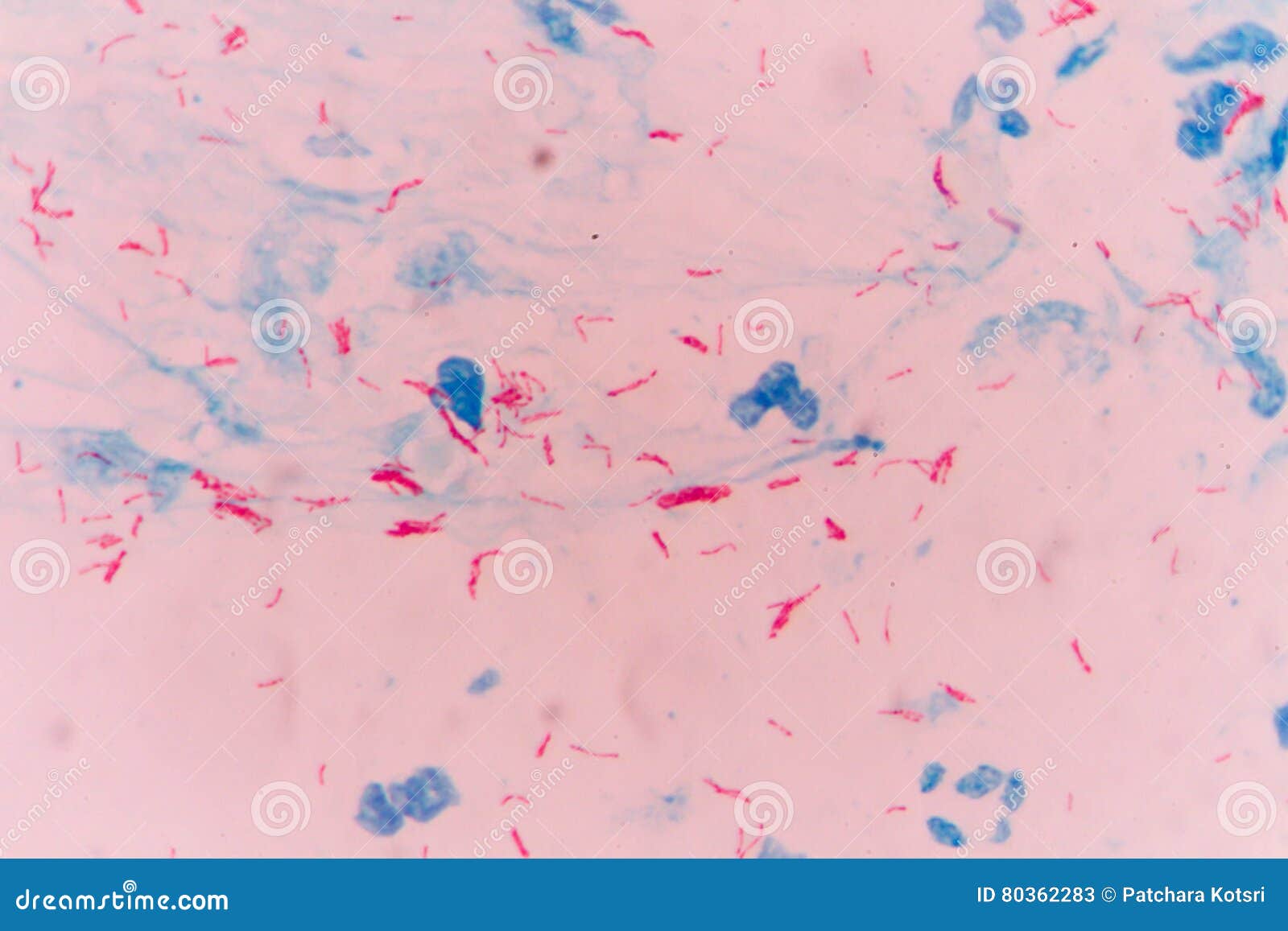 Палочки в мокроте. Микобактерии туберкулеза под микроскопом. Микобактерии туберкулеза микроскопия мокроты. Палочка Коха микроскопия. Палочка Коха по Цилю Нильсену.