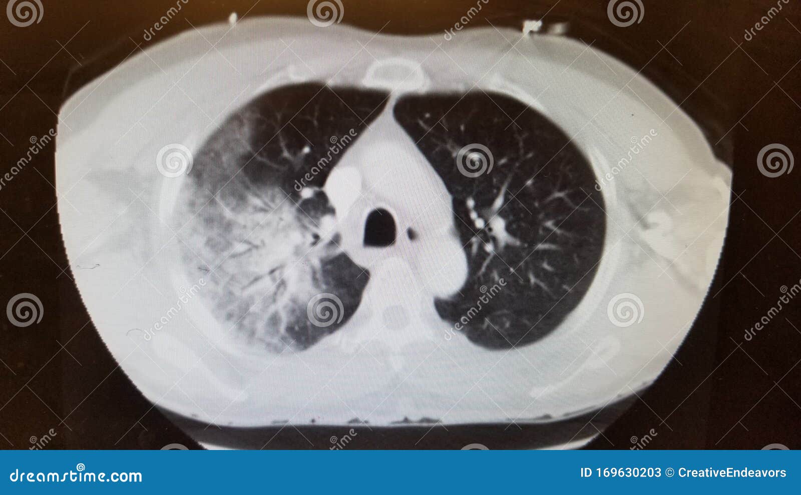 Mycoplasma Pneumonia on Chest CT Stock Image Image of infection, hospital 169630203