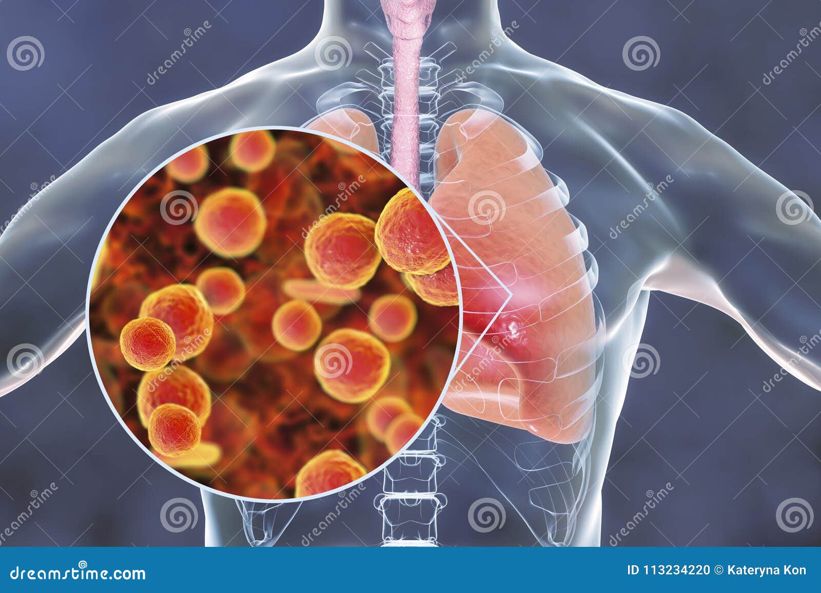 Mycoplasma Pneumoniae Bacteria In Human Lungs Stock Illustration mycoplasma-pneumoniae-bacteria-in-human-lungs-stock-illustration