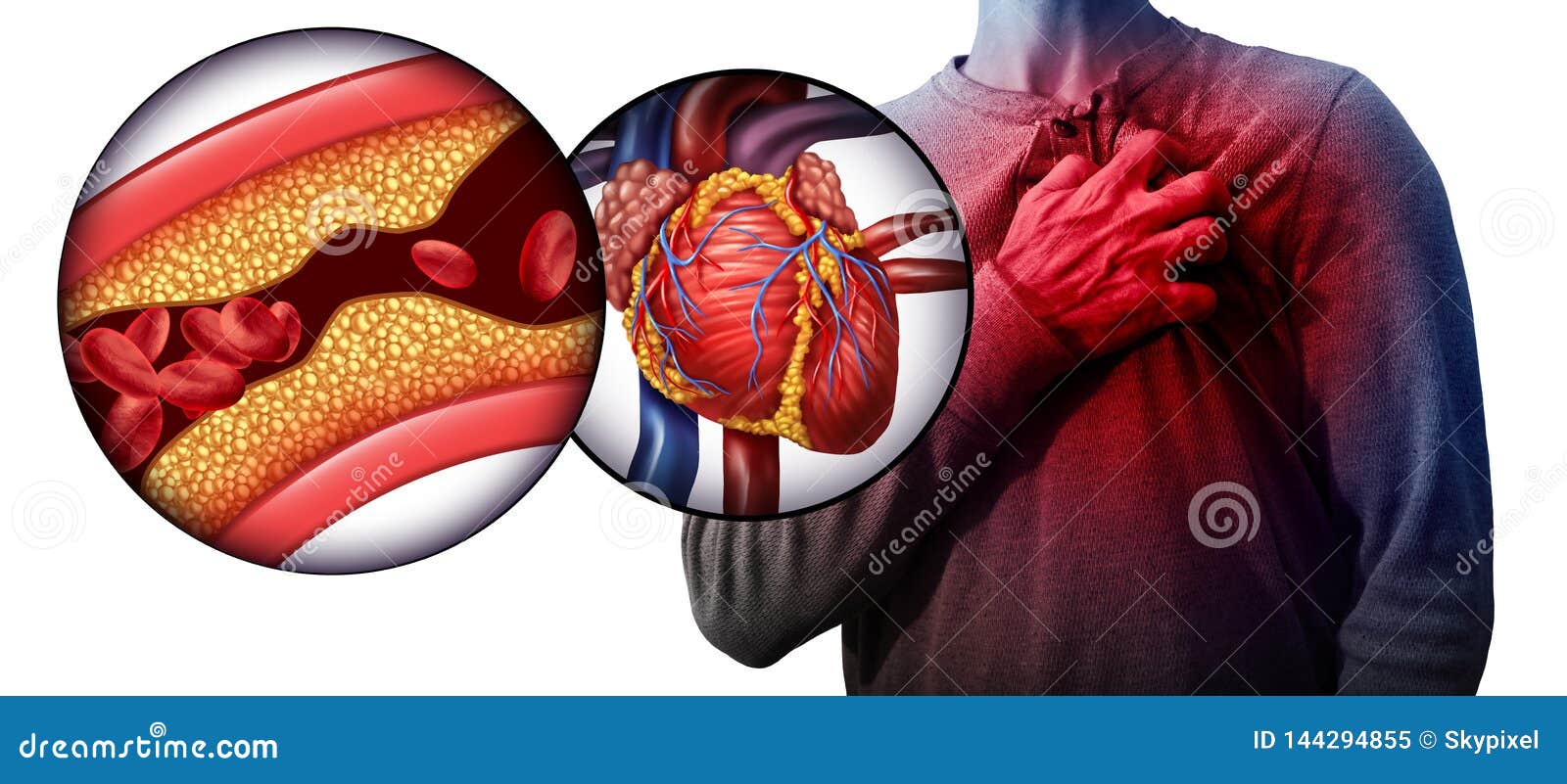 myocardial infarction human heart disease