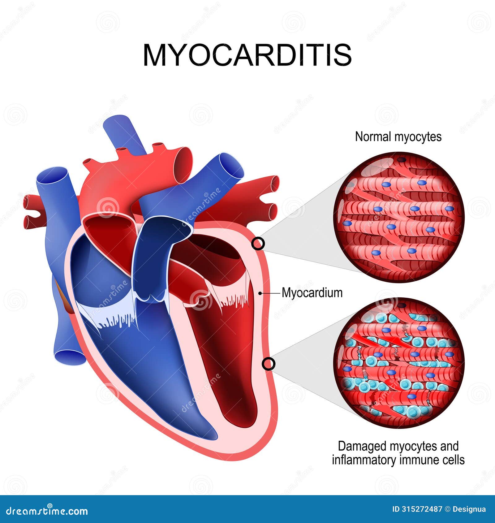 myocarditis. inflammatory cardiomyopathy. cross section of a human heart and myocardium