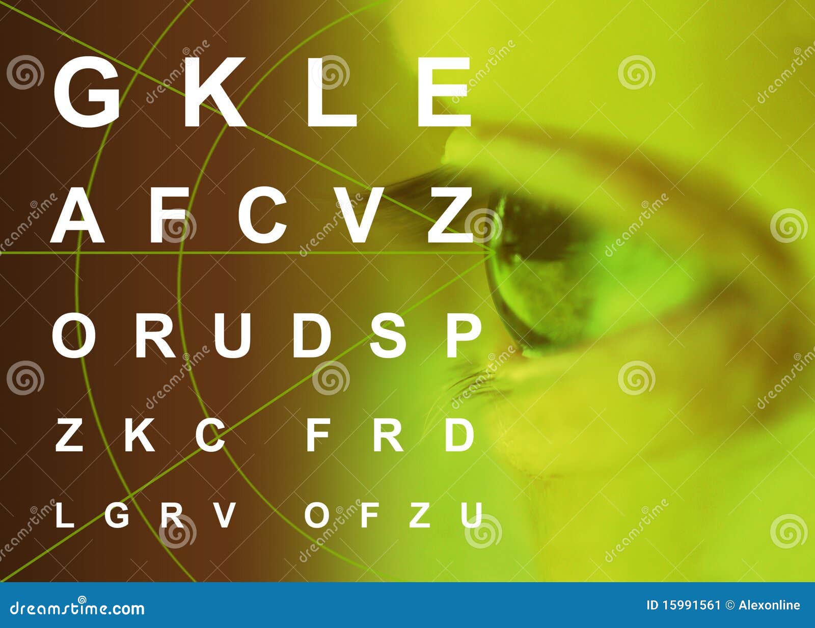 myopia astigmatism