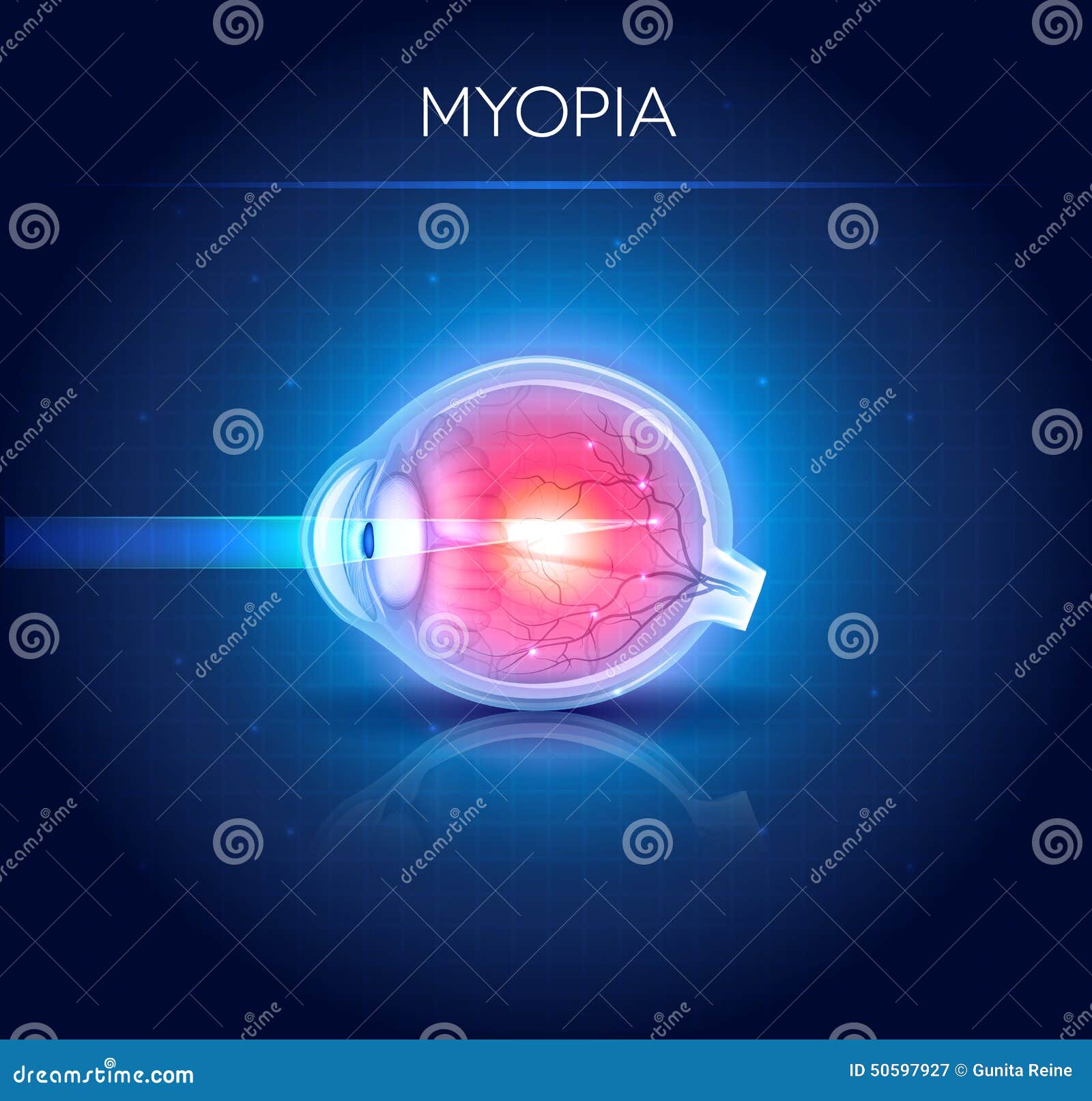 myopia eyesight disorder