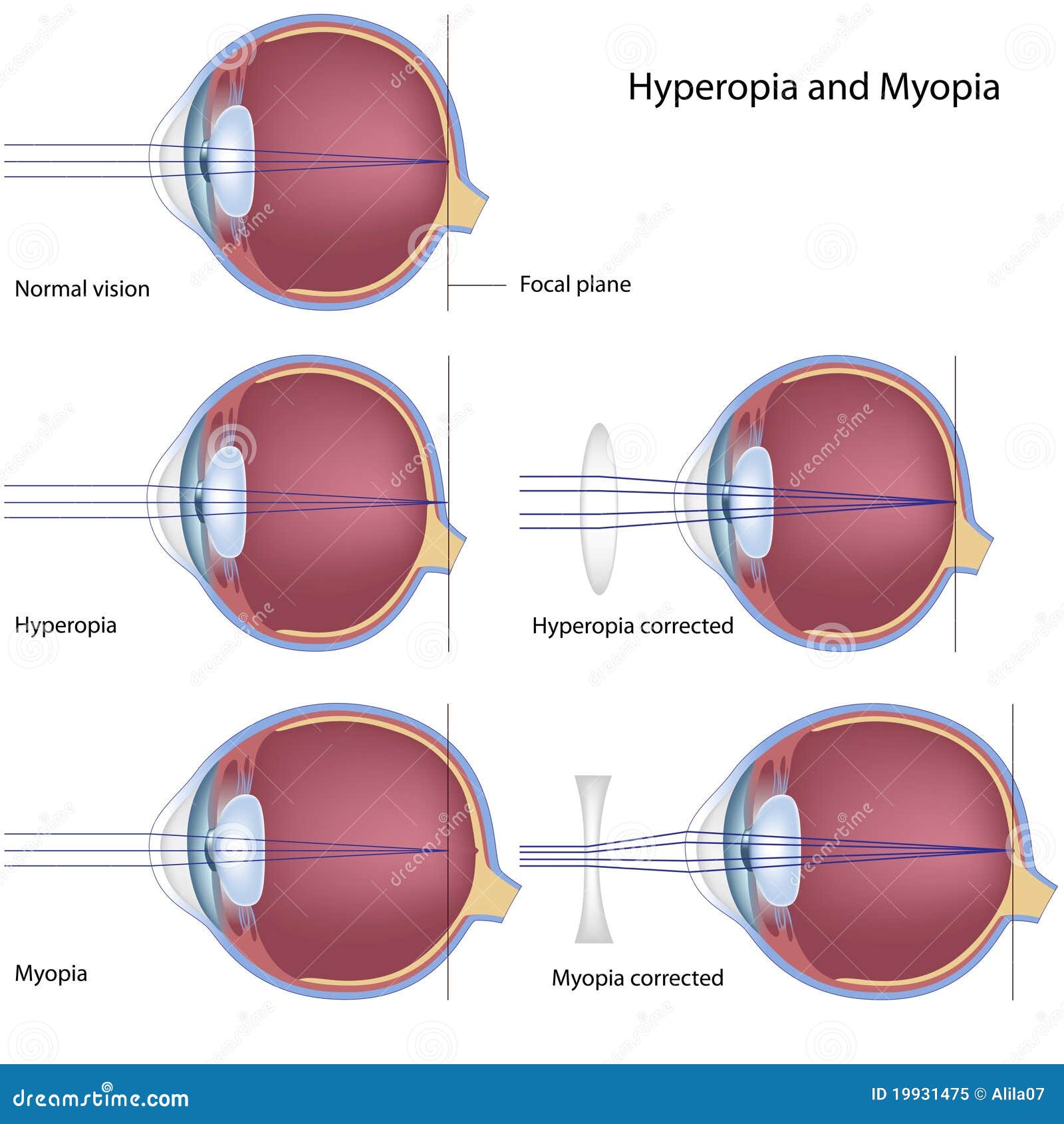 a 2. látás myopia vagy hyperopia