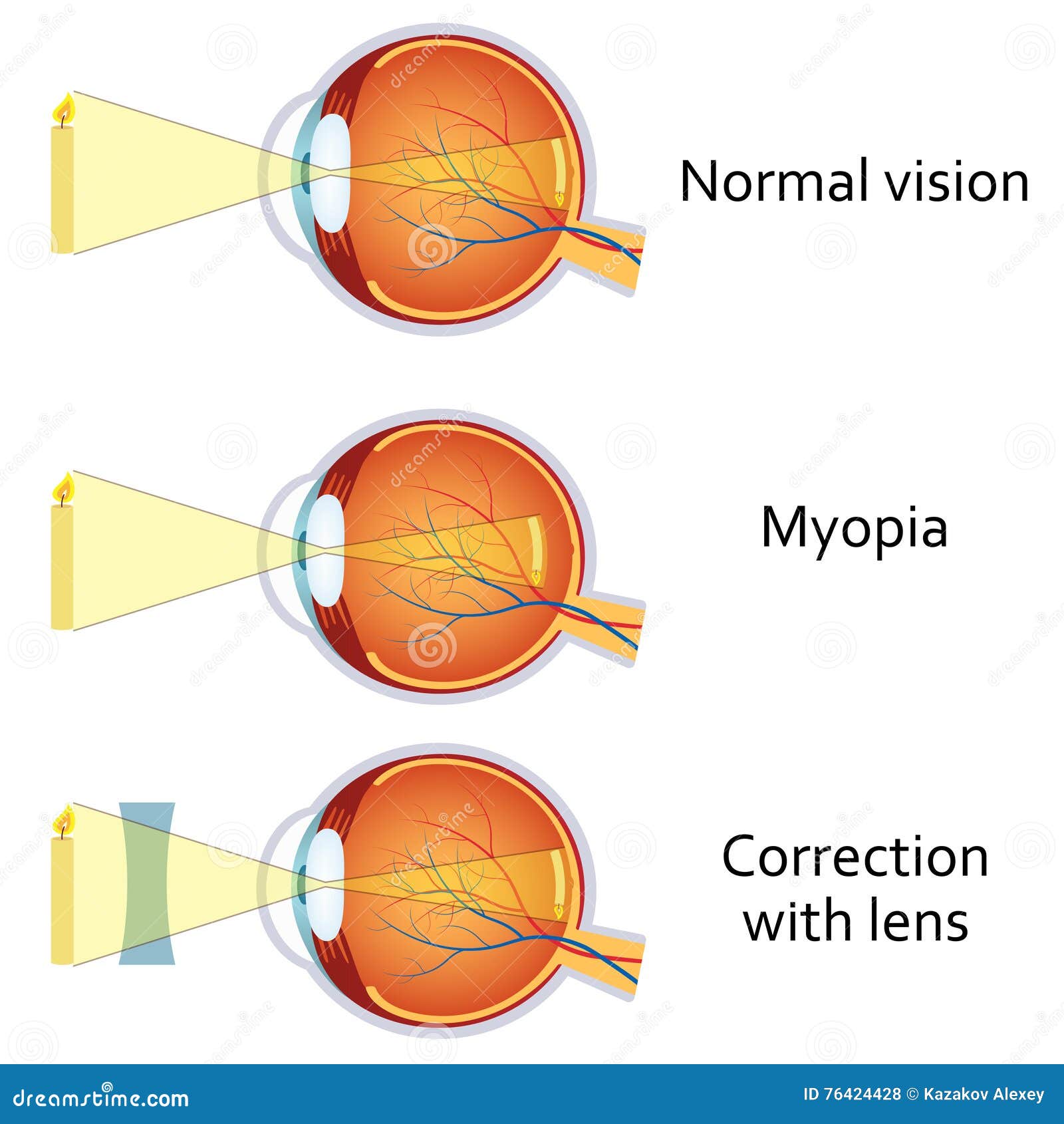 myopia és hyperopia megjelölés)