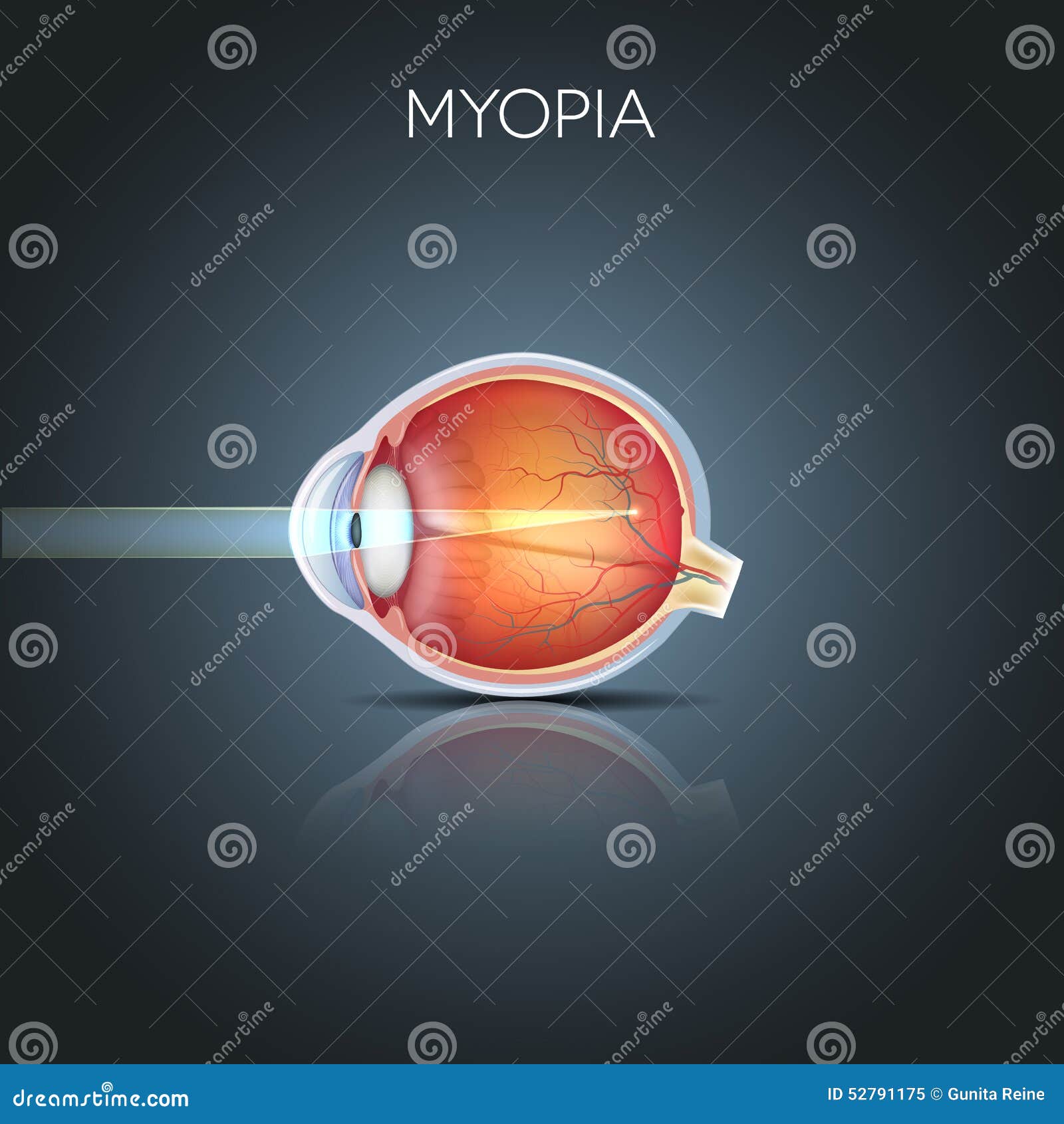 myopia, short sighted eye