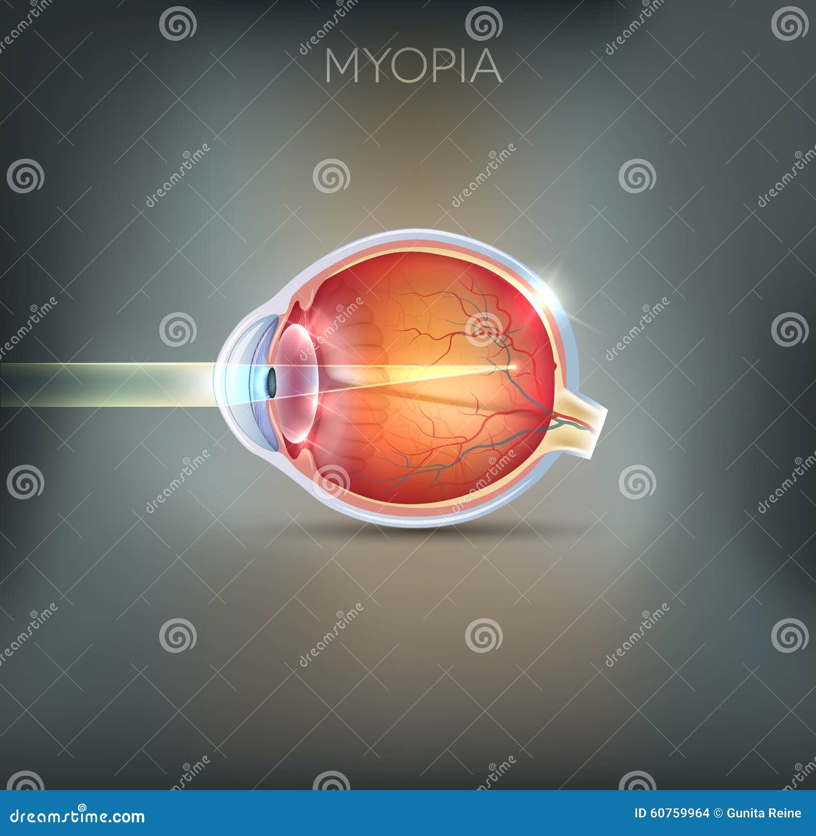 myopia, vision disorder