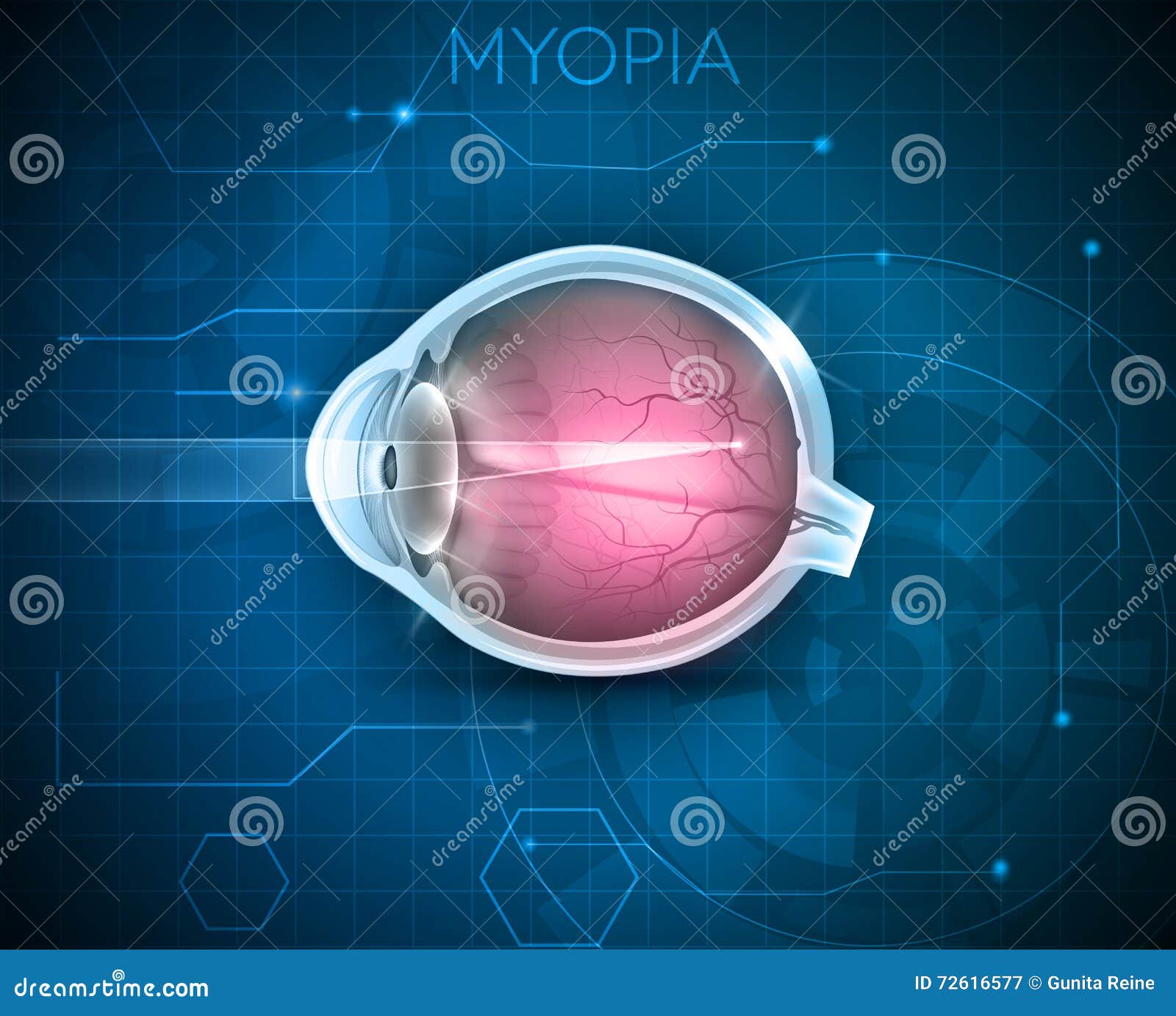 myopia, vision disorder